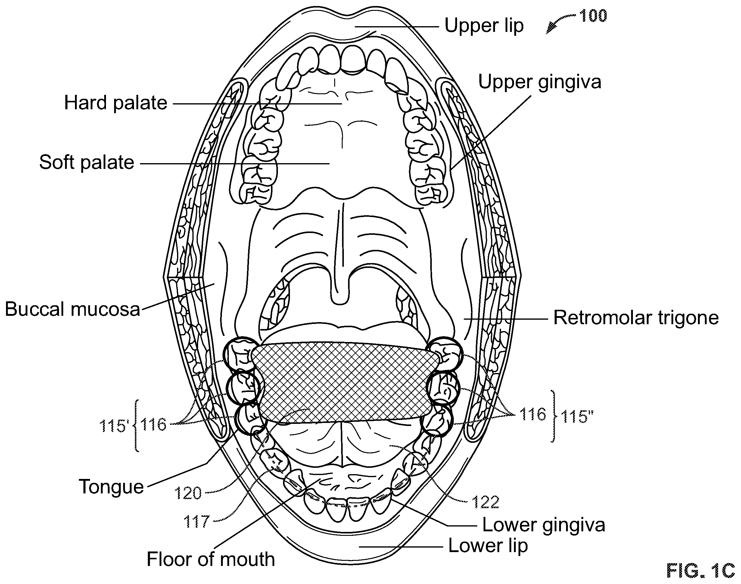 Patent US12496212 Figure 3 – Devices for treating obstructive sleep apnea