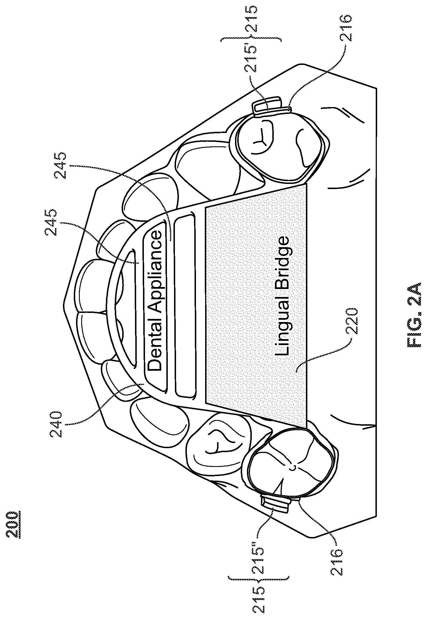 Patent US12496212 Figure 5 – Devices for treating obstructive sleep apnea