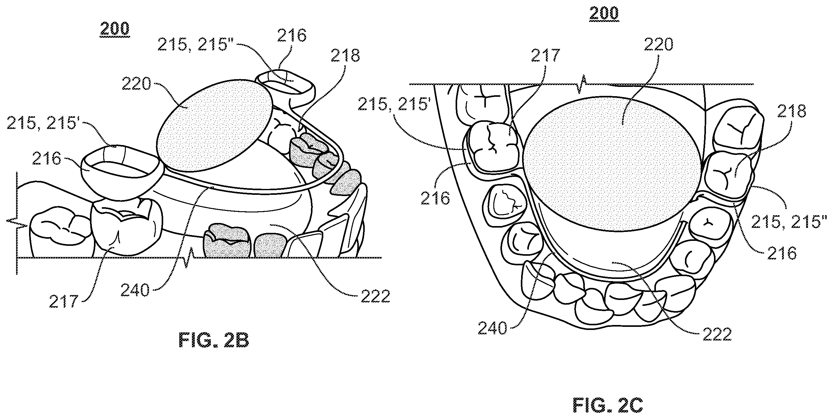 Patent US12496212 Figure 6 – Devices for treating obstructive sleep apnea