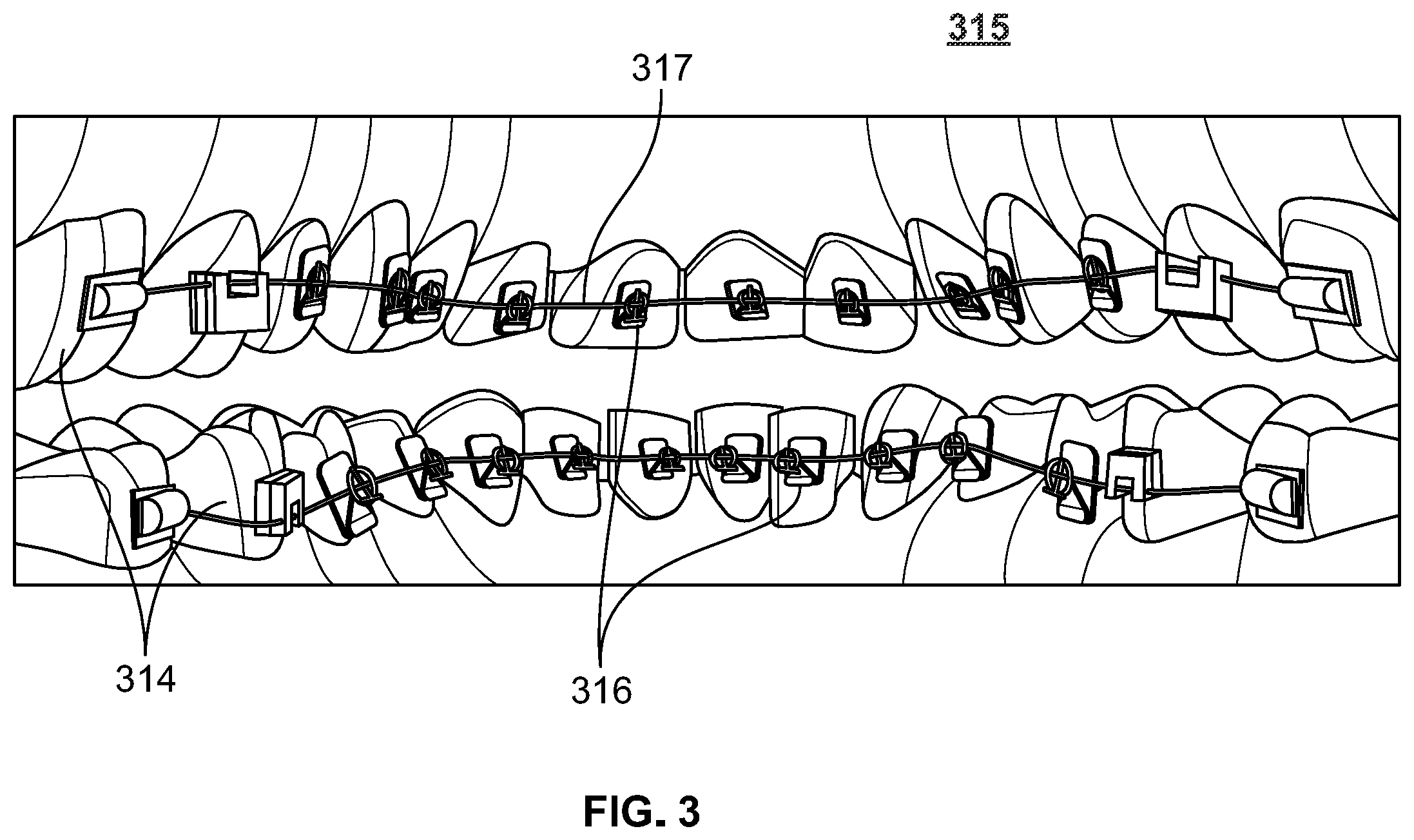 Patent US12496212 Figure 7 – Devices for treating obstructive sleep apnea