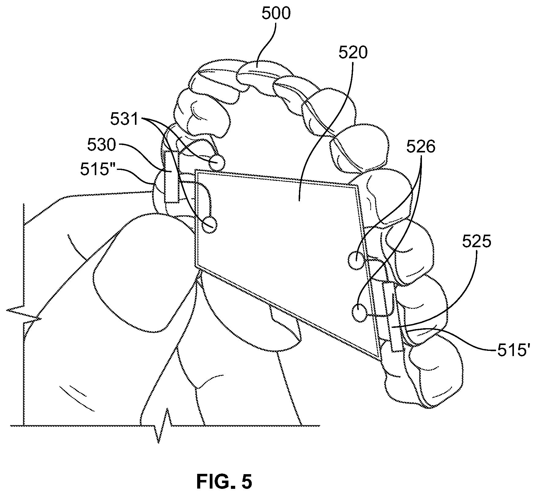 Patent US12496212 Figure 9 – Devices for treating obstructive sleep apnea