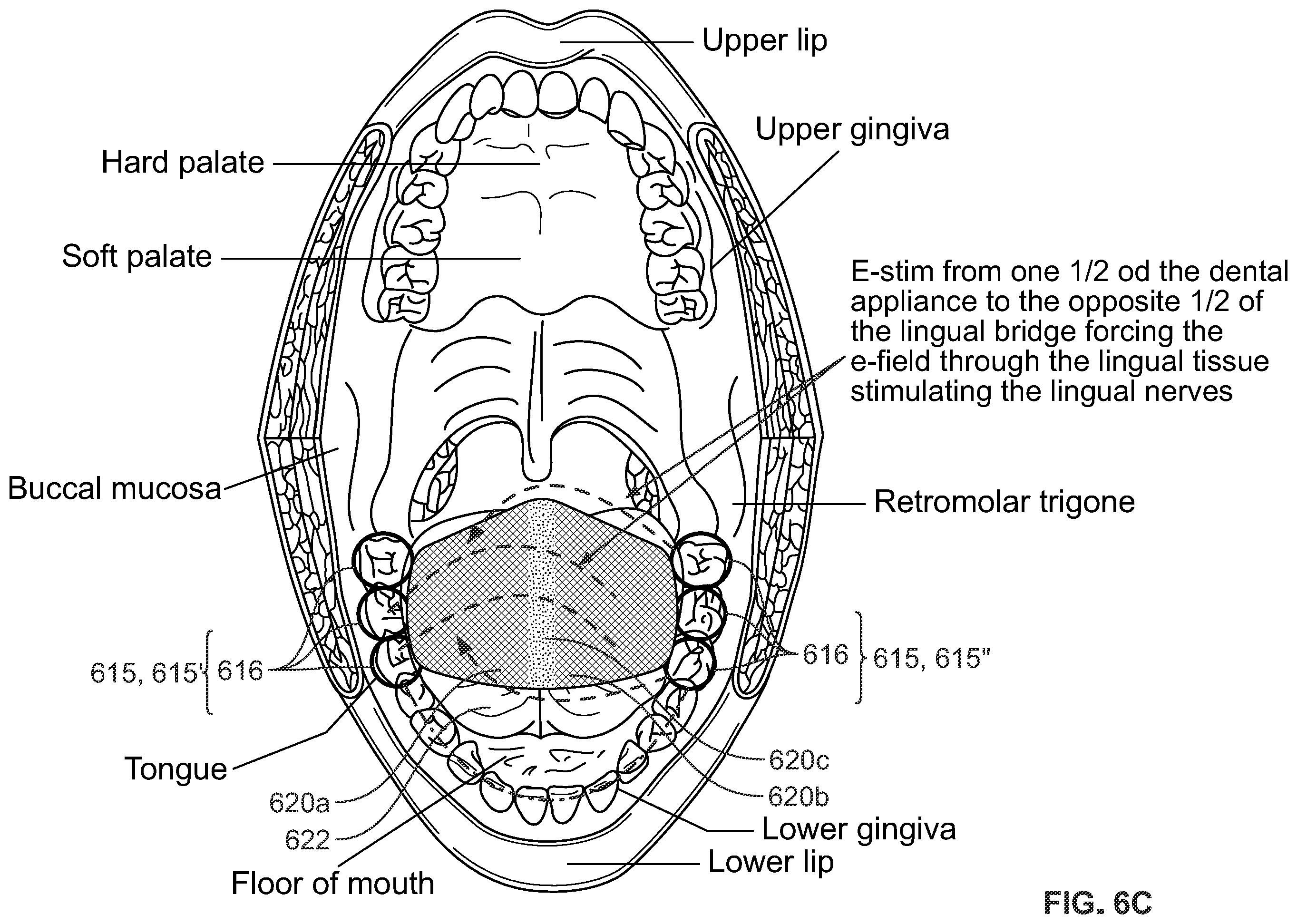 Patent US12496212 Figure 12 – Devices for treating obstructive sleep apnea