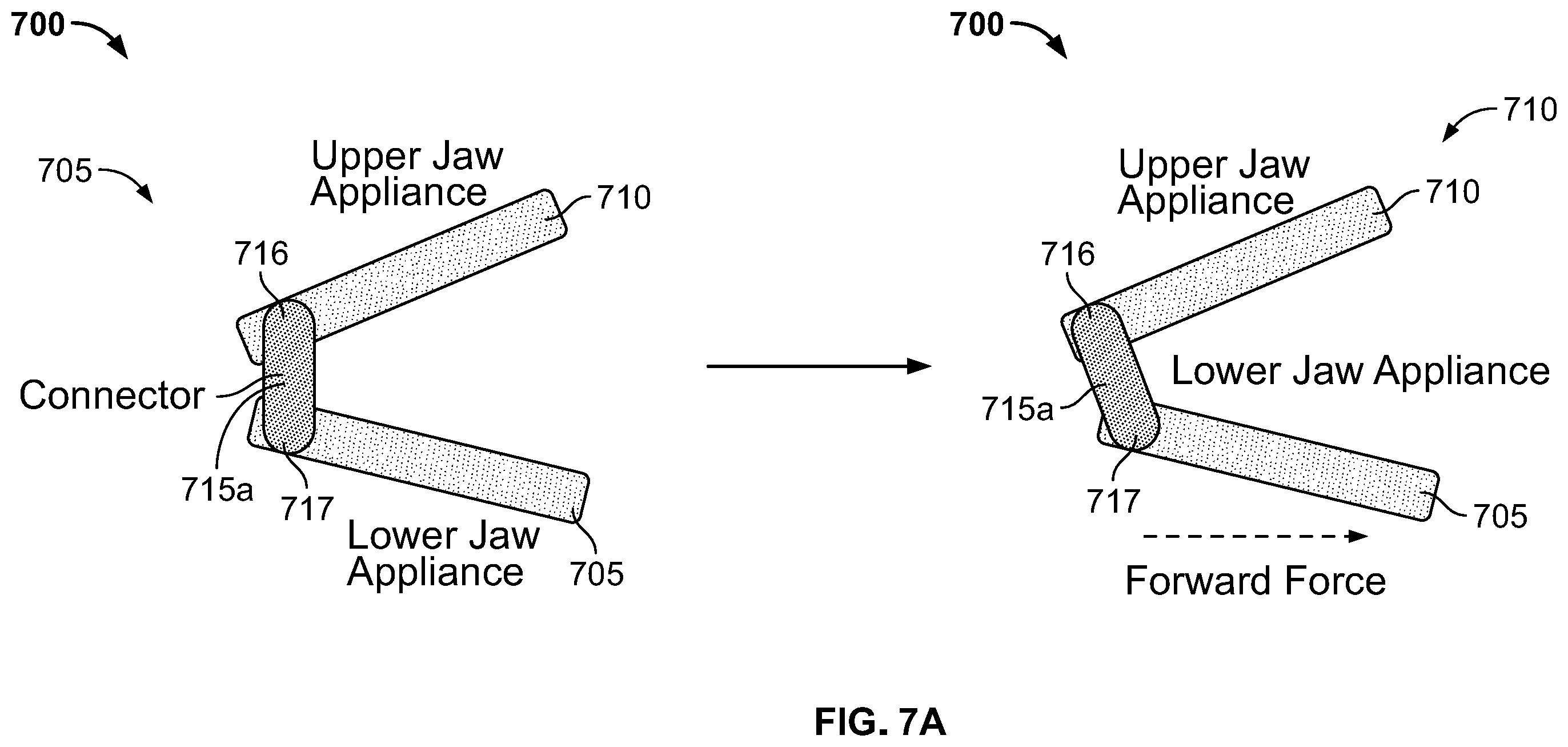 Patent US12496212 Figure 14 – Devices for treating obstructive sleep apnea