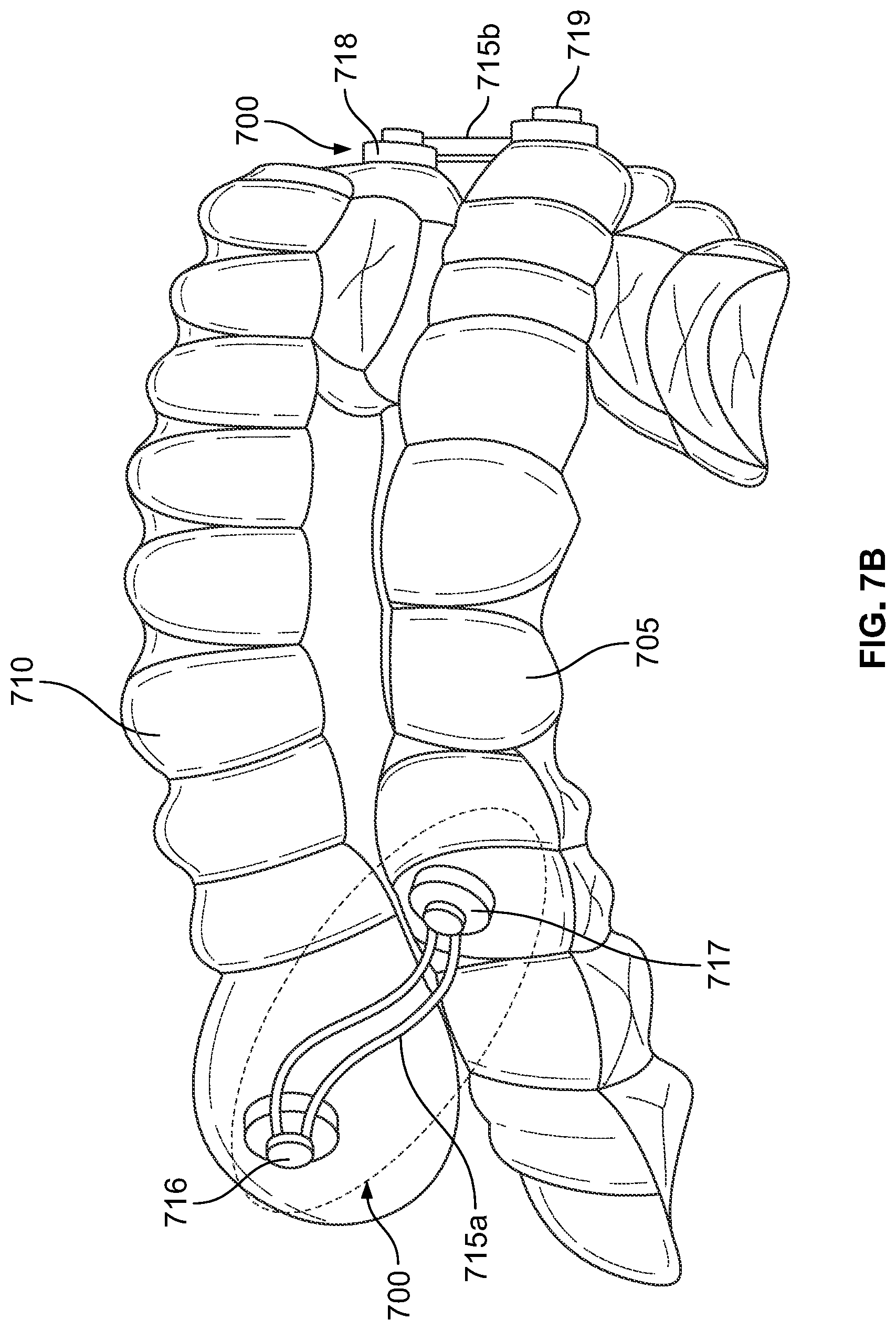 Patent US12496212 Figure 15 – Devices for treating obstructive sleep apnea