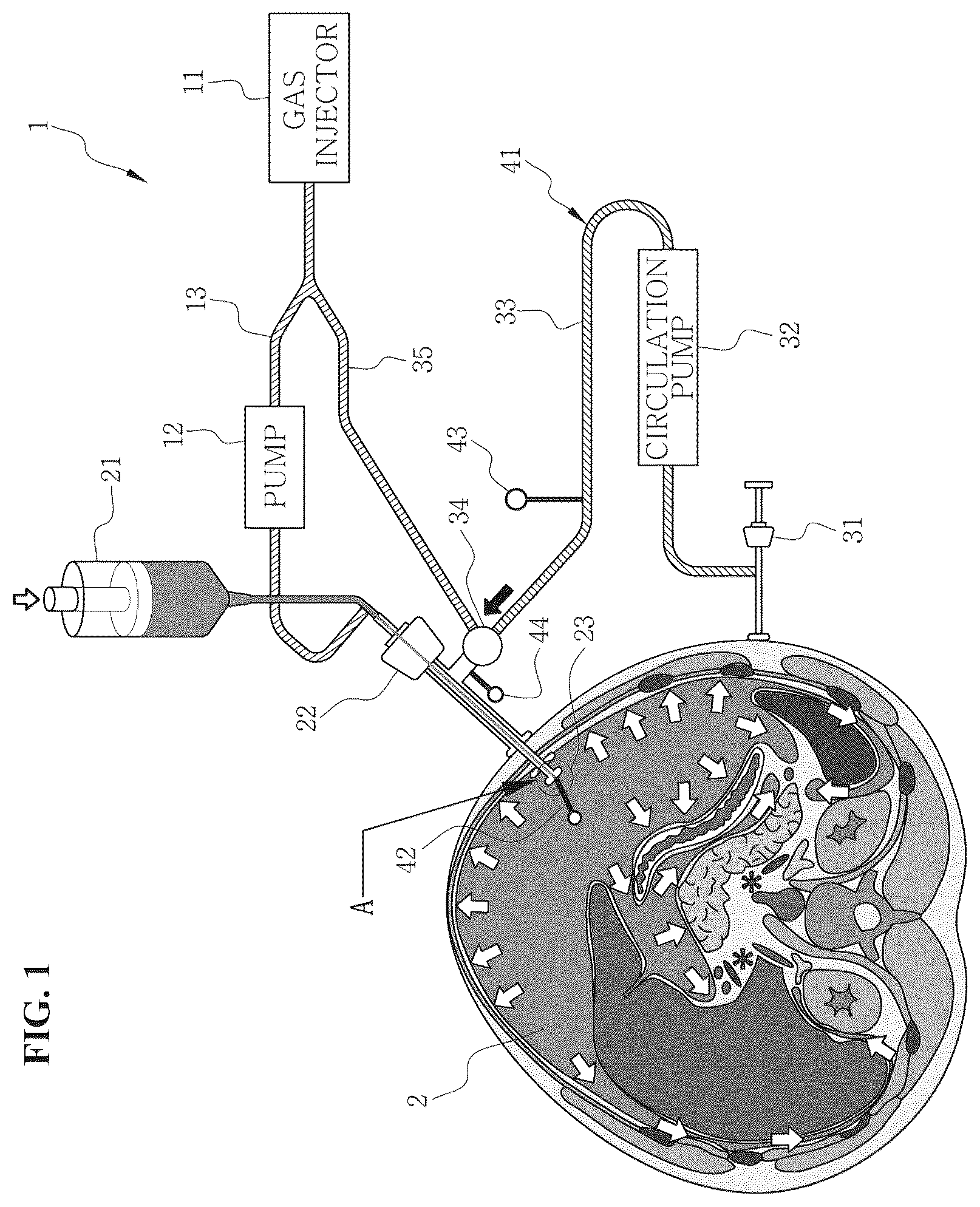 Patent US12496217 Figure 1 – System for circulating hyperthermic pressurized gas in peritoneal cavity, and intraperitoneal gas providing system including two-fluid nozzle