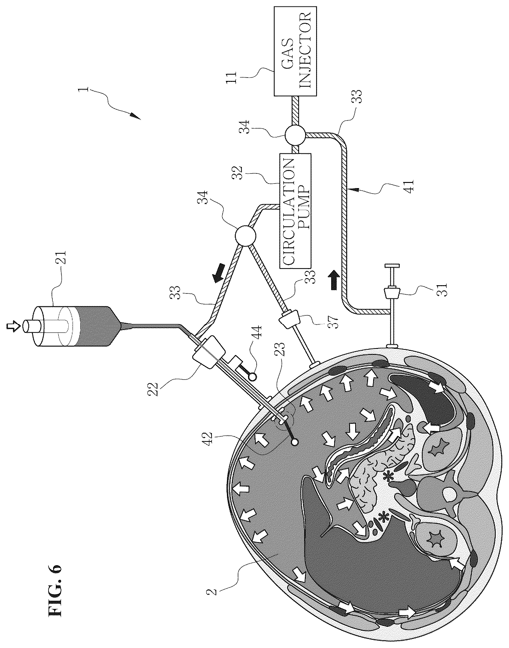 Patent US12496217 Figure 6 – System for circulating hyperthermic pressurized gas in peritoneal cavity, and intraperitoneal gas providing system including two-fluid nozzle