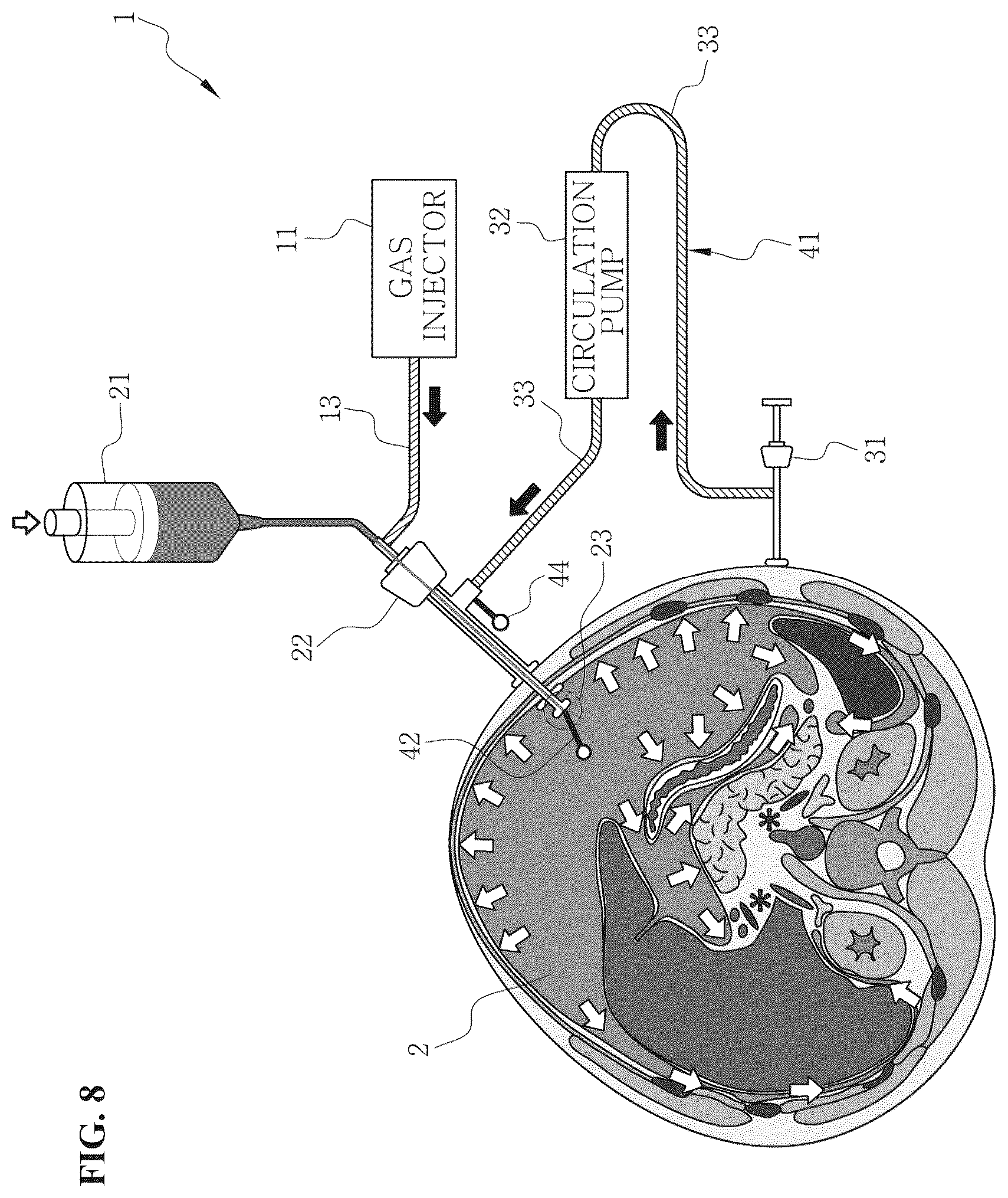 Patent US12496217 Figure 8 – System for circulating hyperthermic pressurized gas in peritoneal cavity, and intraperitoneal gas providing system including two-fluid nozzle