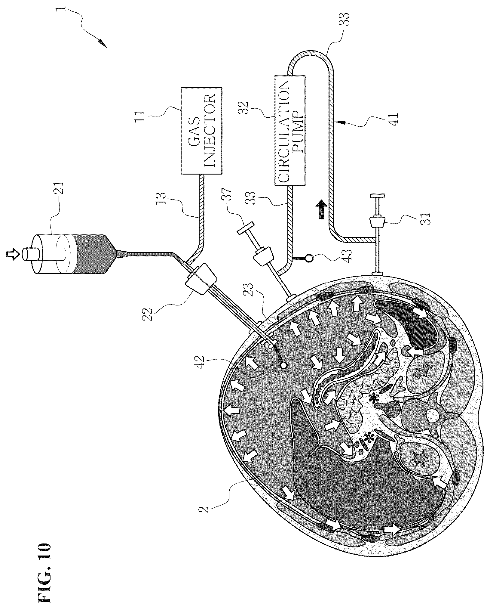 Patent US12496217 Figure 10 – System for circulating hyperthermic pressurized gas in peritoneal cavity, and intraperitoneal gas providing system including two-fluid nozzle