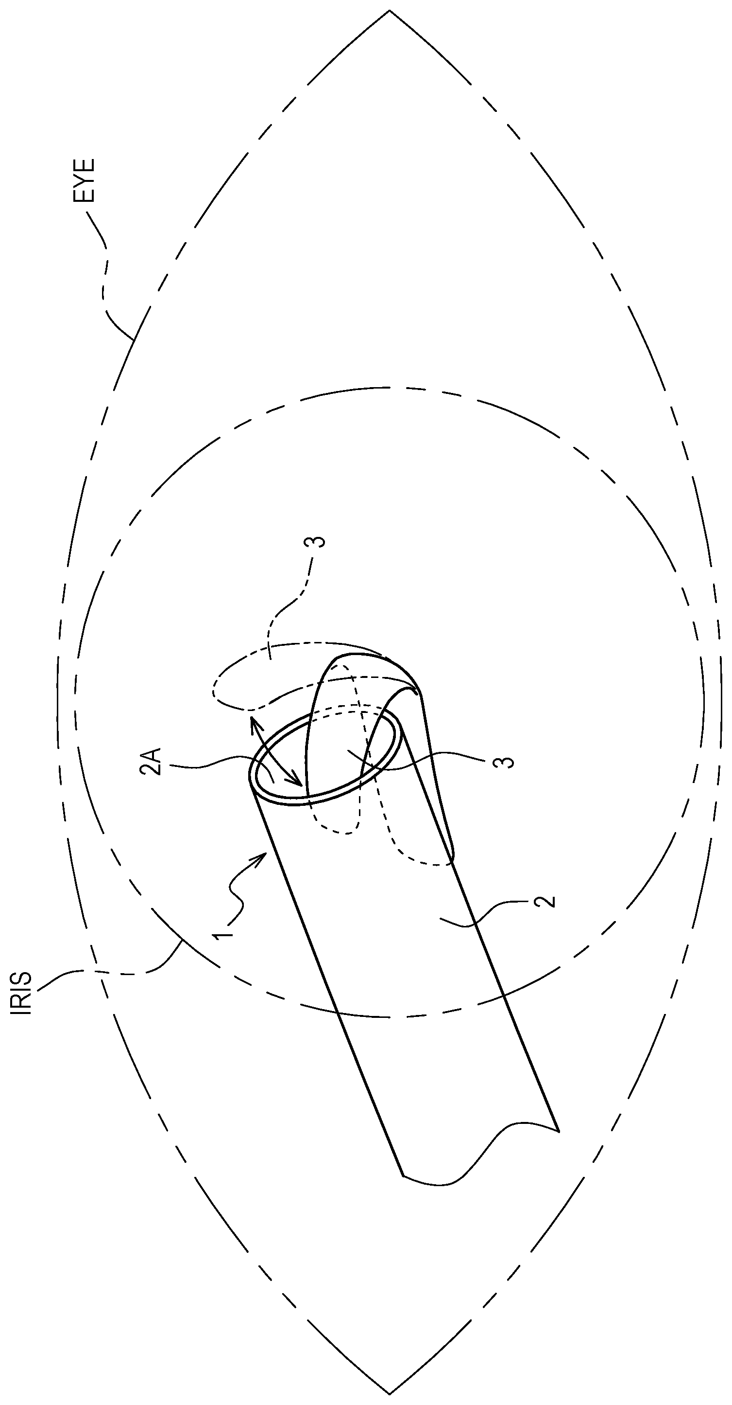 Patent US12496219 Figure 1 – Glaucoma drainage tube