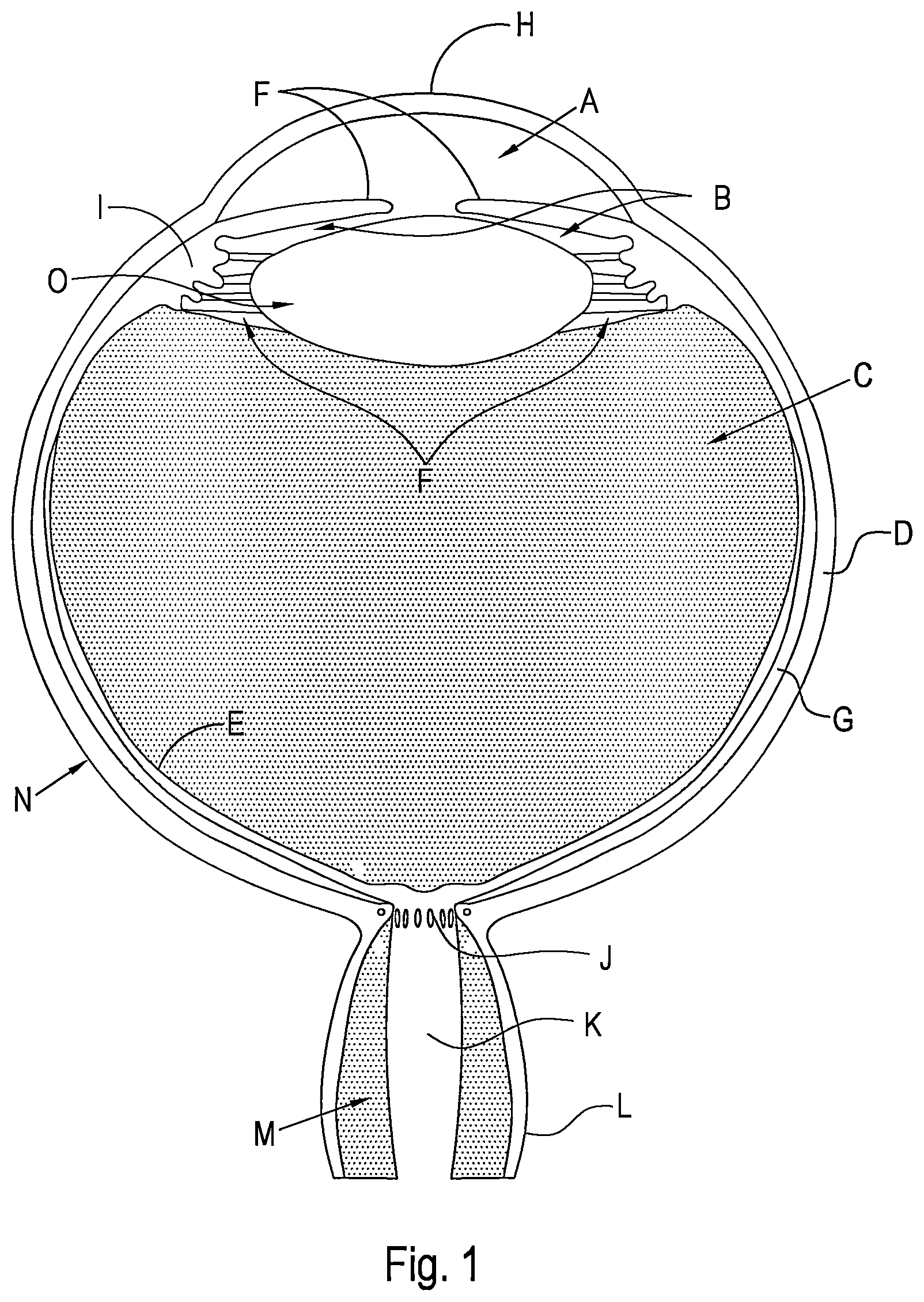 Patent US12496221 Figure 1 – Shunt and method for treating glaucoma