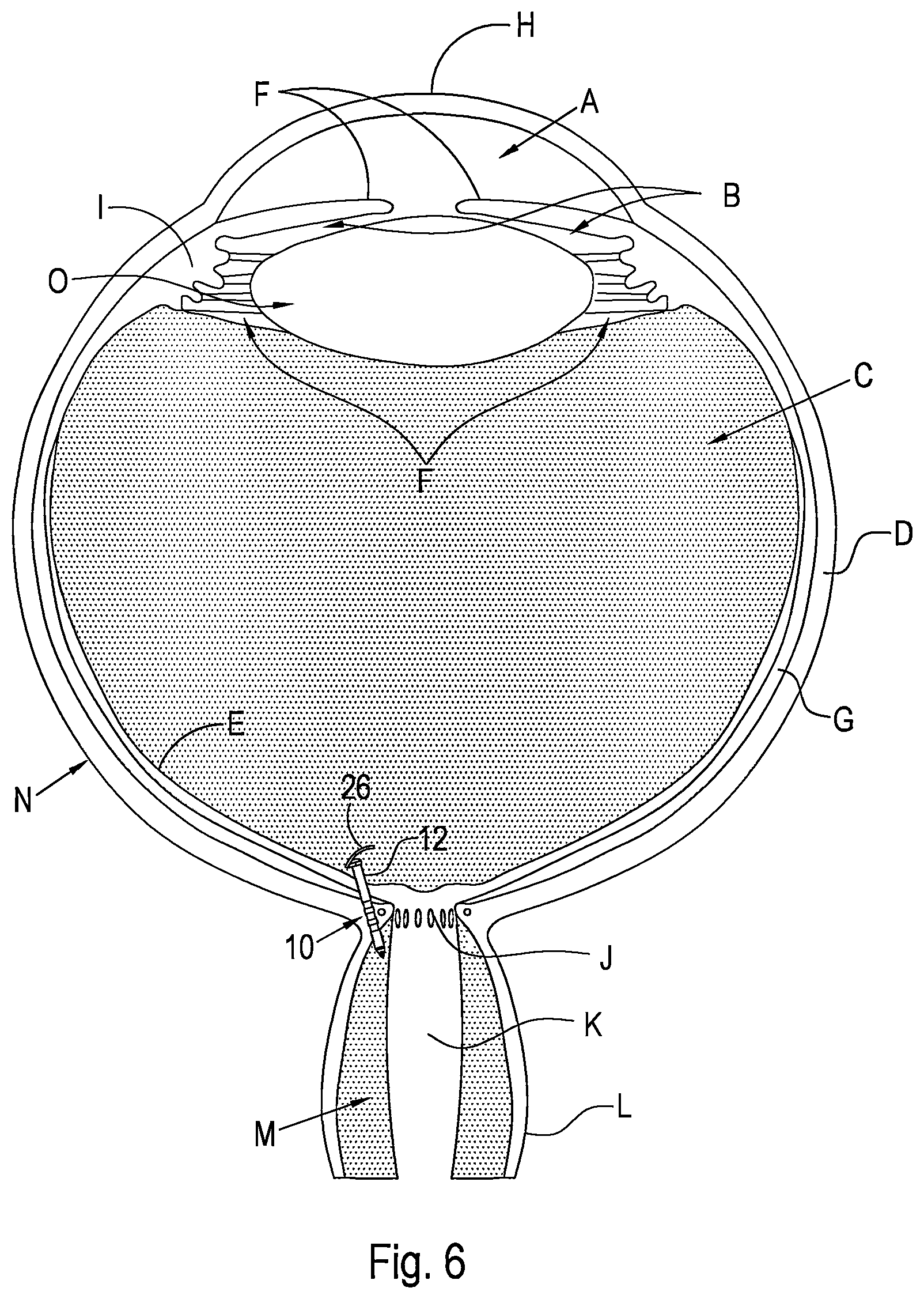 Patent US12496221 Figure 3 – Shunt and method for treating glaucoma