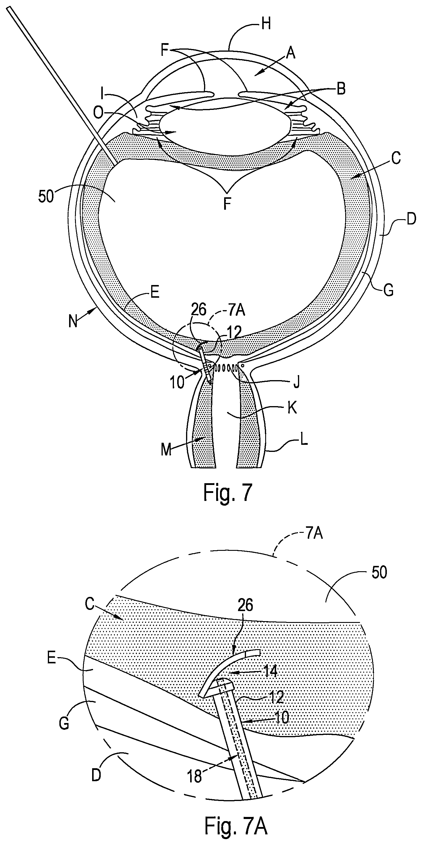 Patent US12496221 Figure 4 – Shunt and method for treating glaucoma