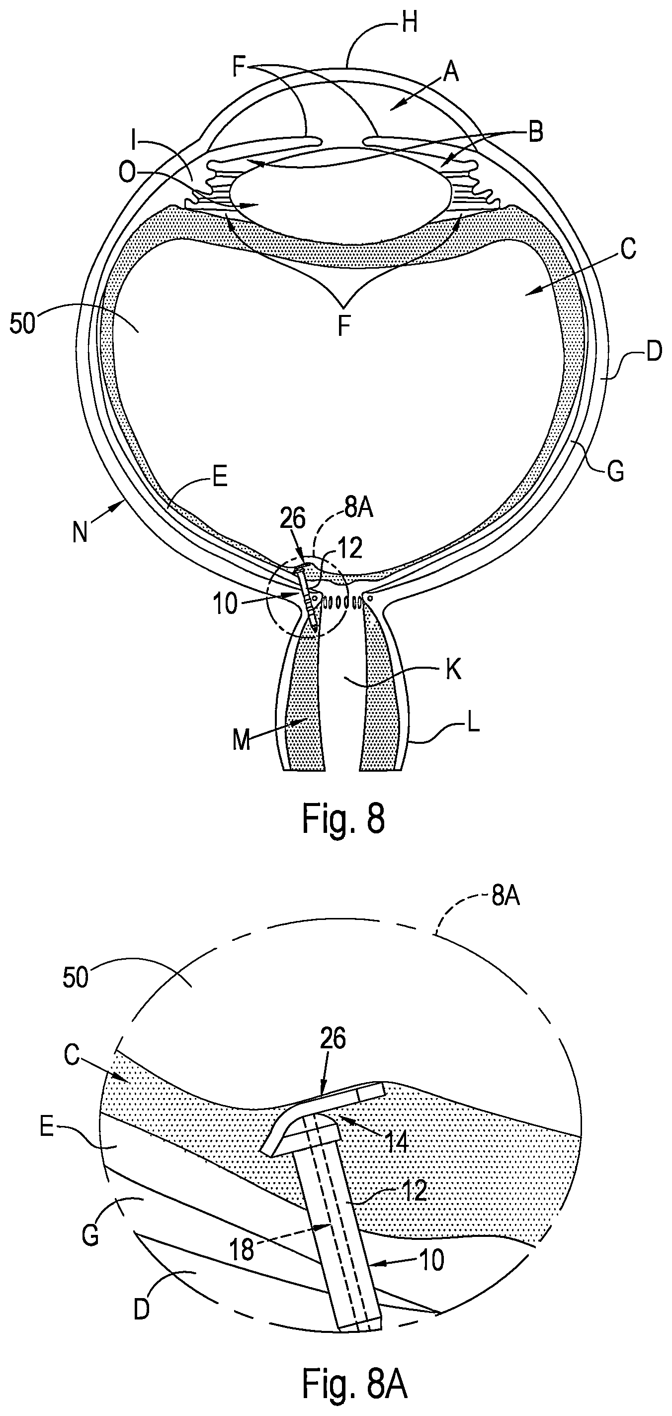 Patent US12496221 Figure 5 – Shunt and method for treating glaucoma