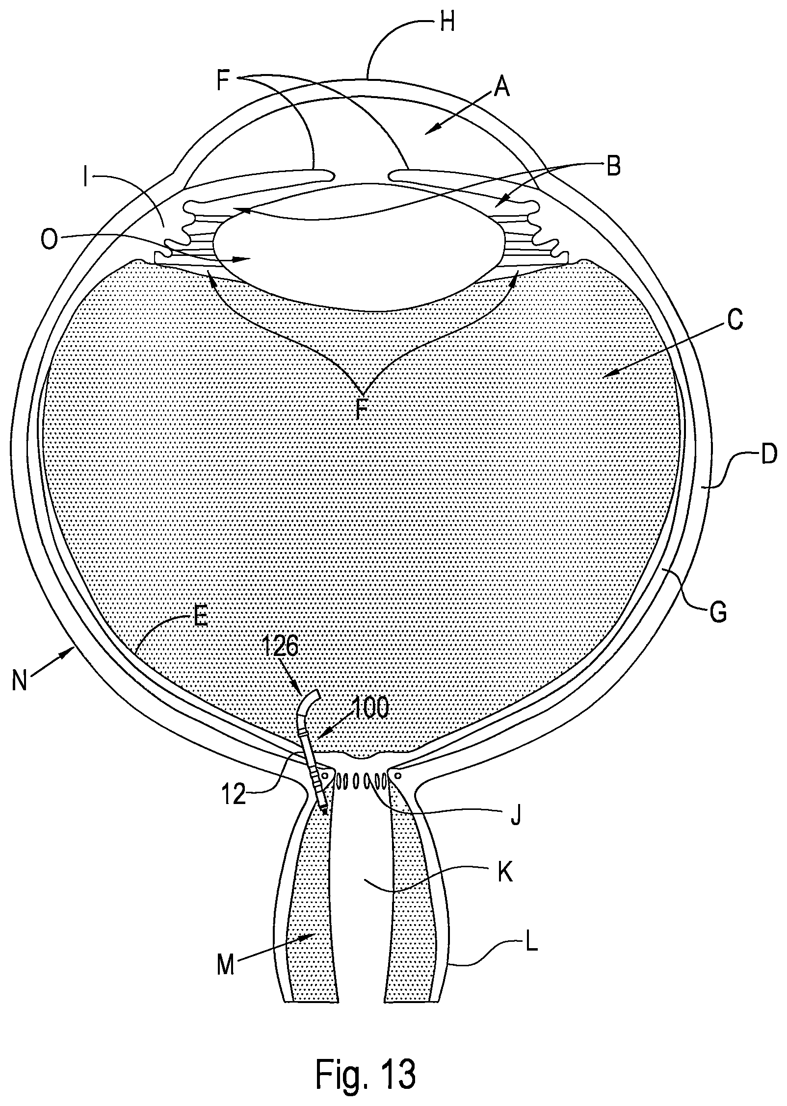Patent US12496221 Figure 7 – Shunt and method for treating glaucoma