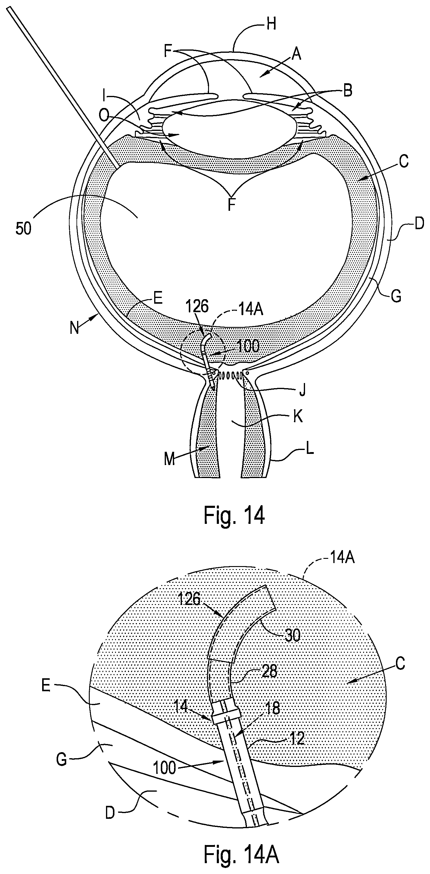 Patent US12496221 Figure 8 – Shunt and method for treating glaucoma