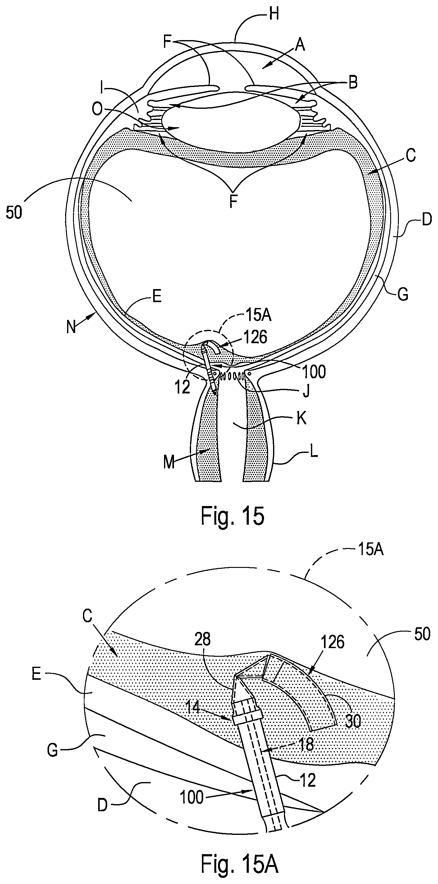 Patent US12496221 Figure 9 – Shunt and method for treating glaucoma