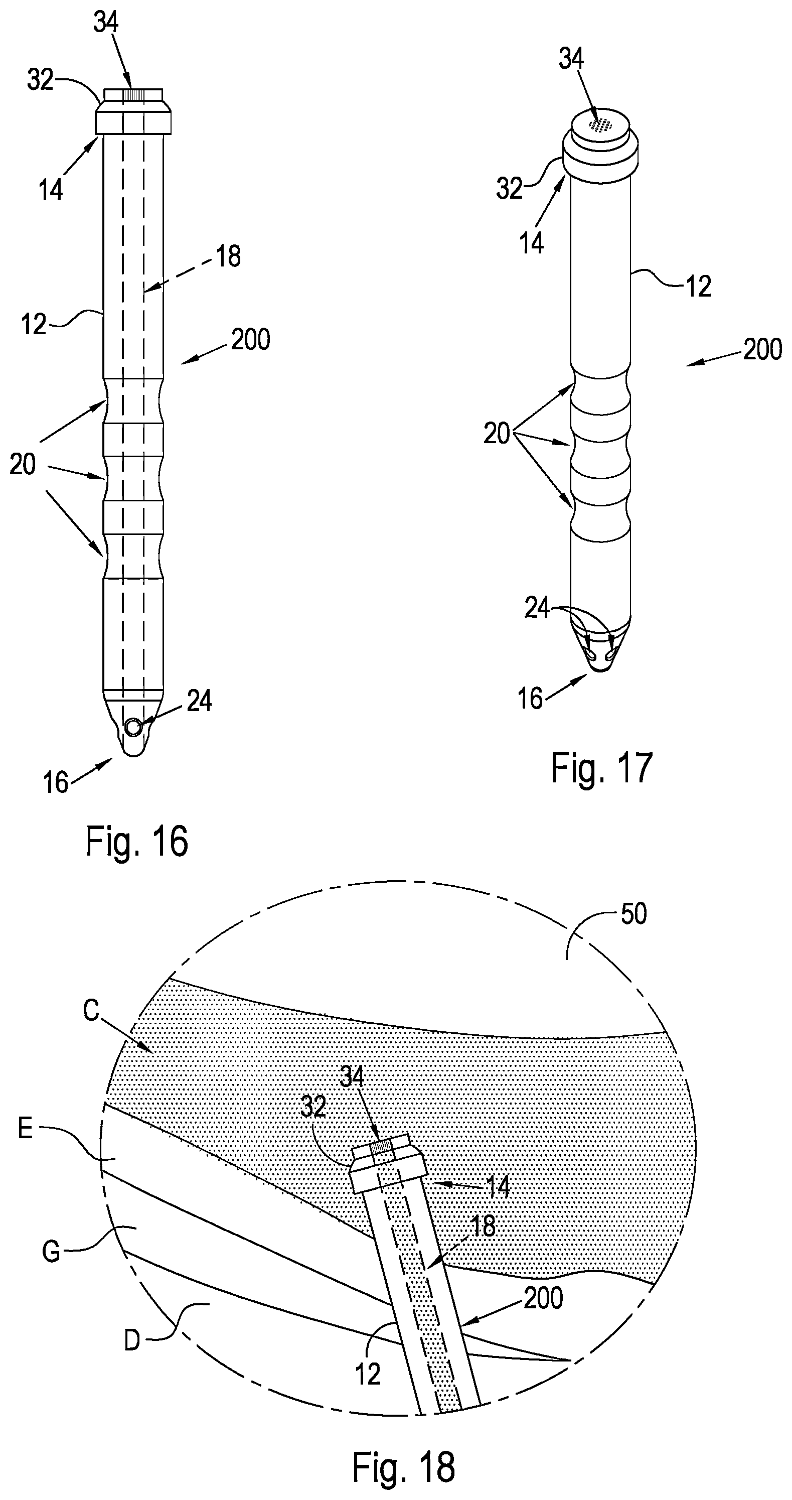 Patent US12496221 Figure 10 – Shunt and method for treating glaucoma