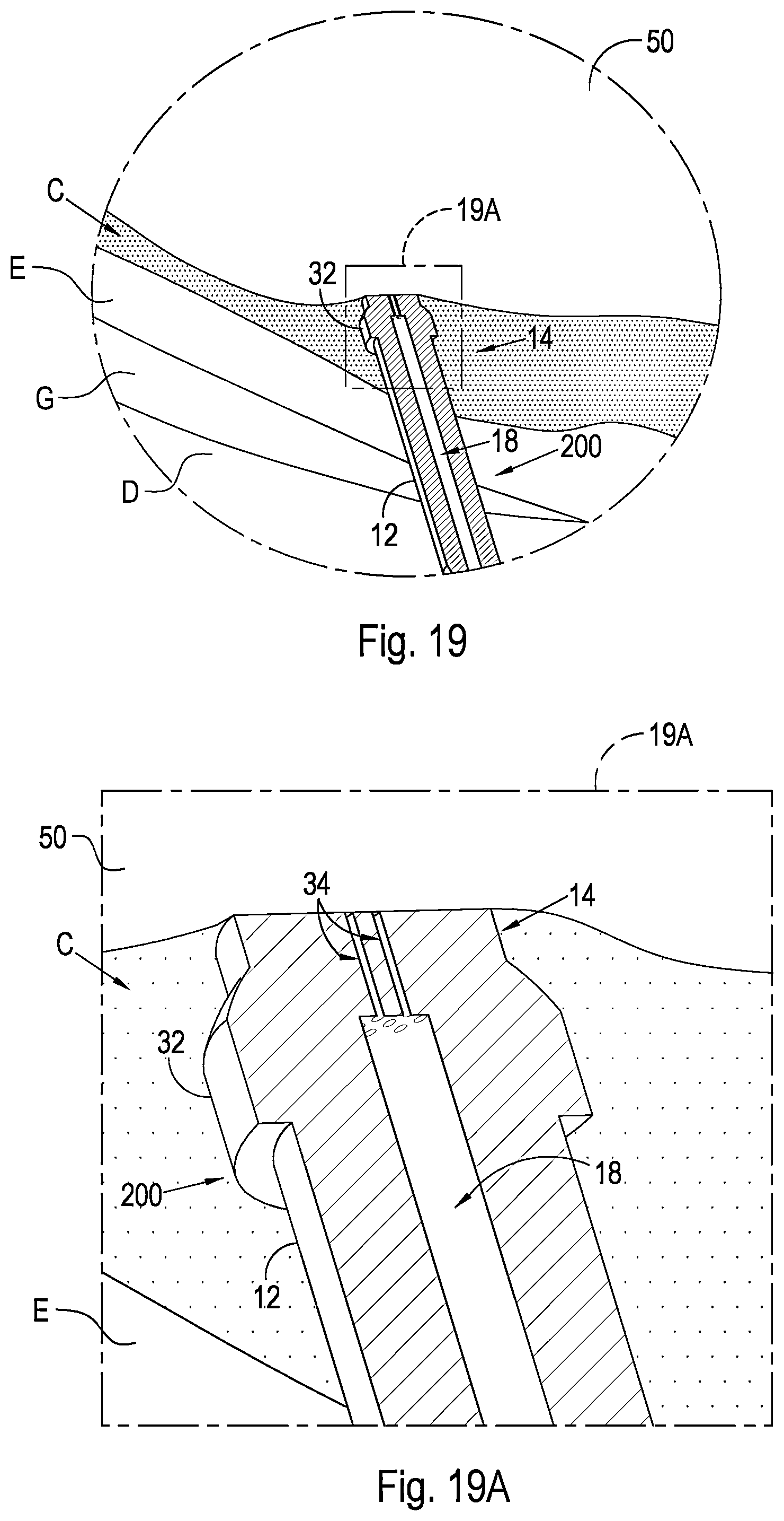 Patent US12496221 Figure 11 – Shunt and method for treating glaucoma
