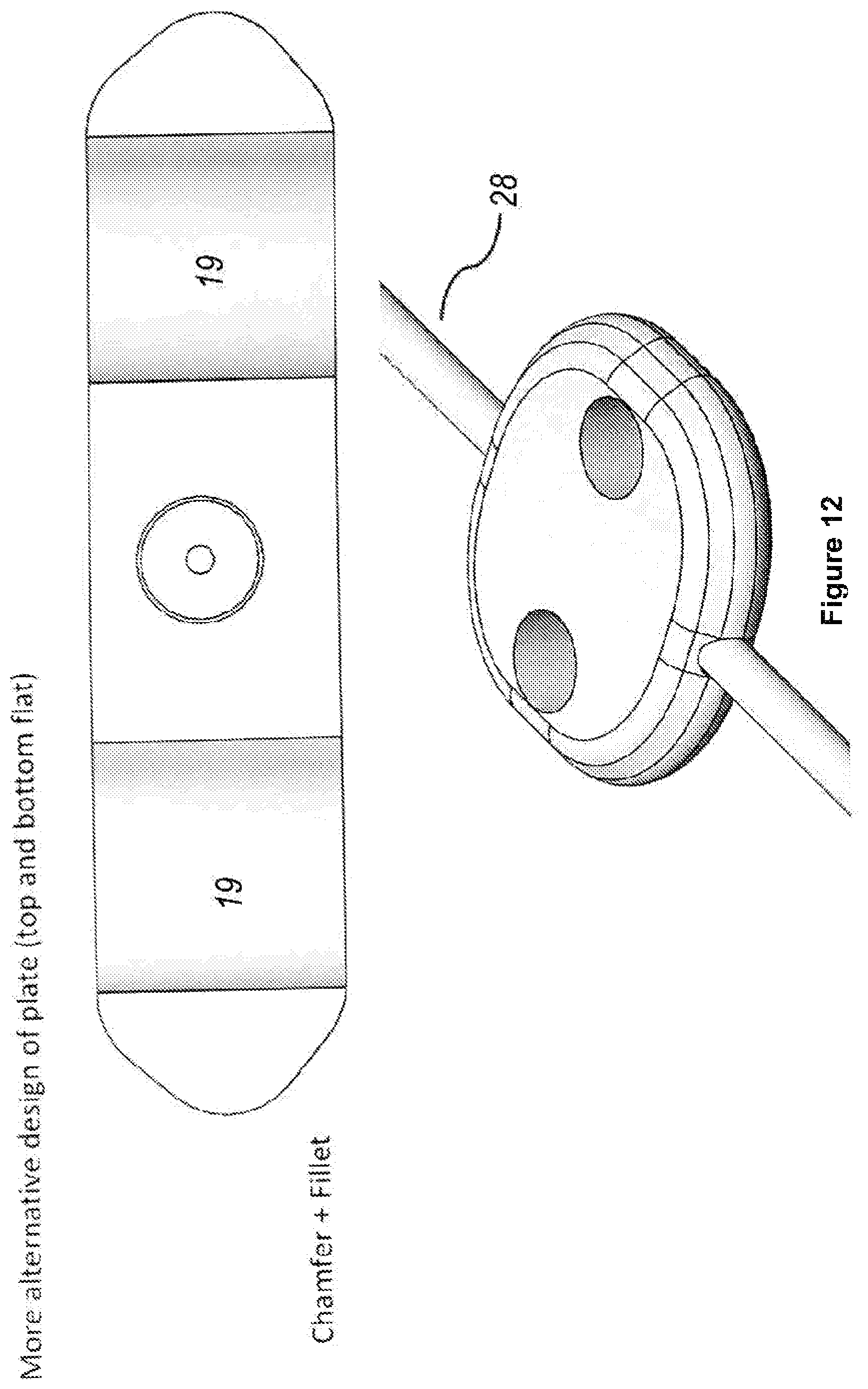 Patent US12496222 Figure 12 – Ocular drainage implant