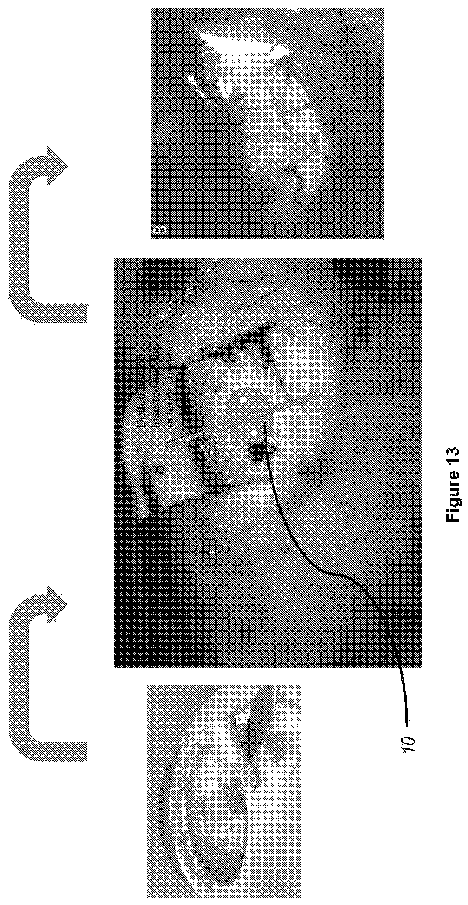 Patent US12496222 Figure 13 – Ocular drainage implant