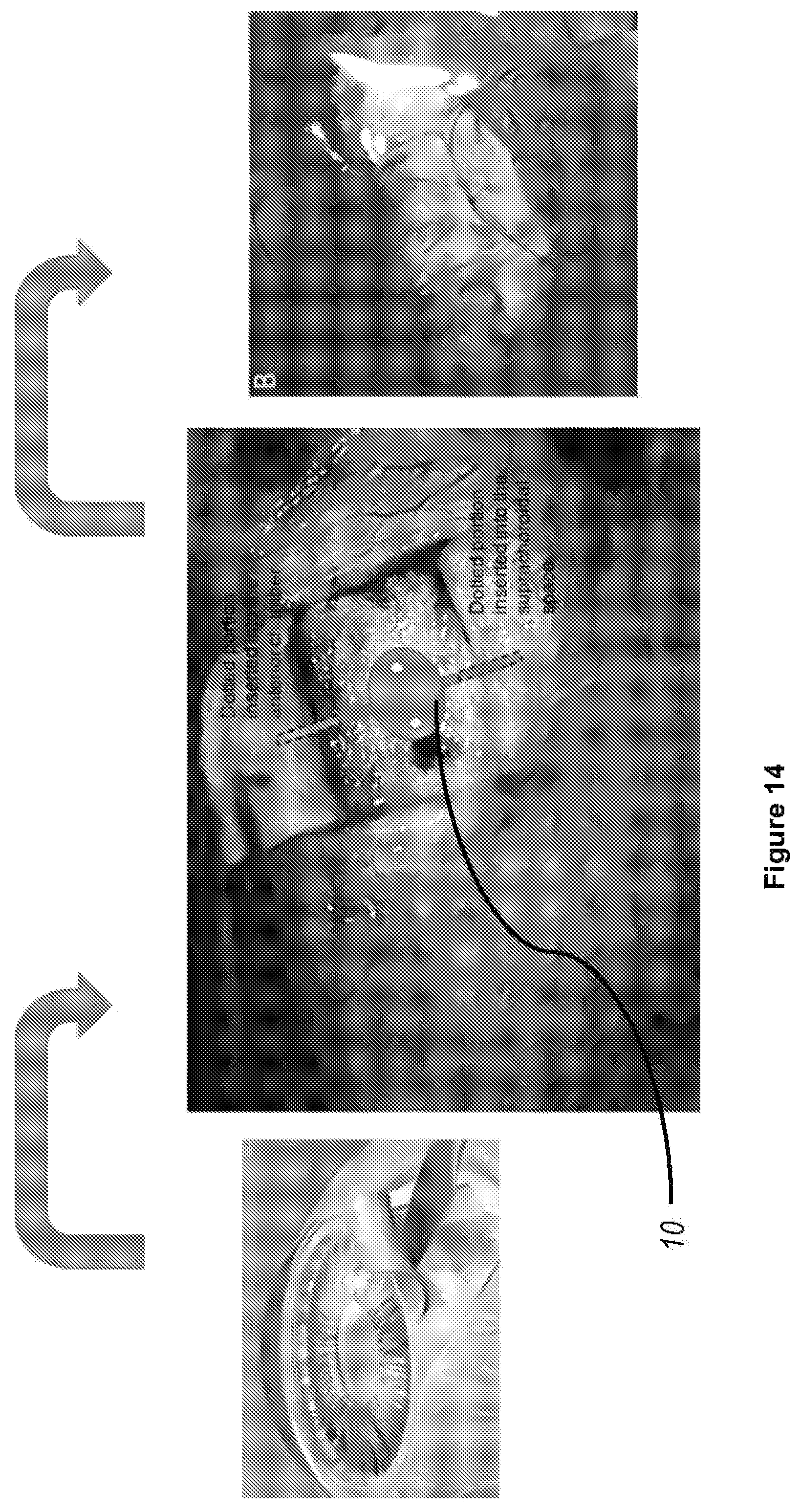 Patent US12496222 Figure 14 – Ocular drainage implant