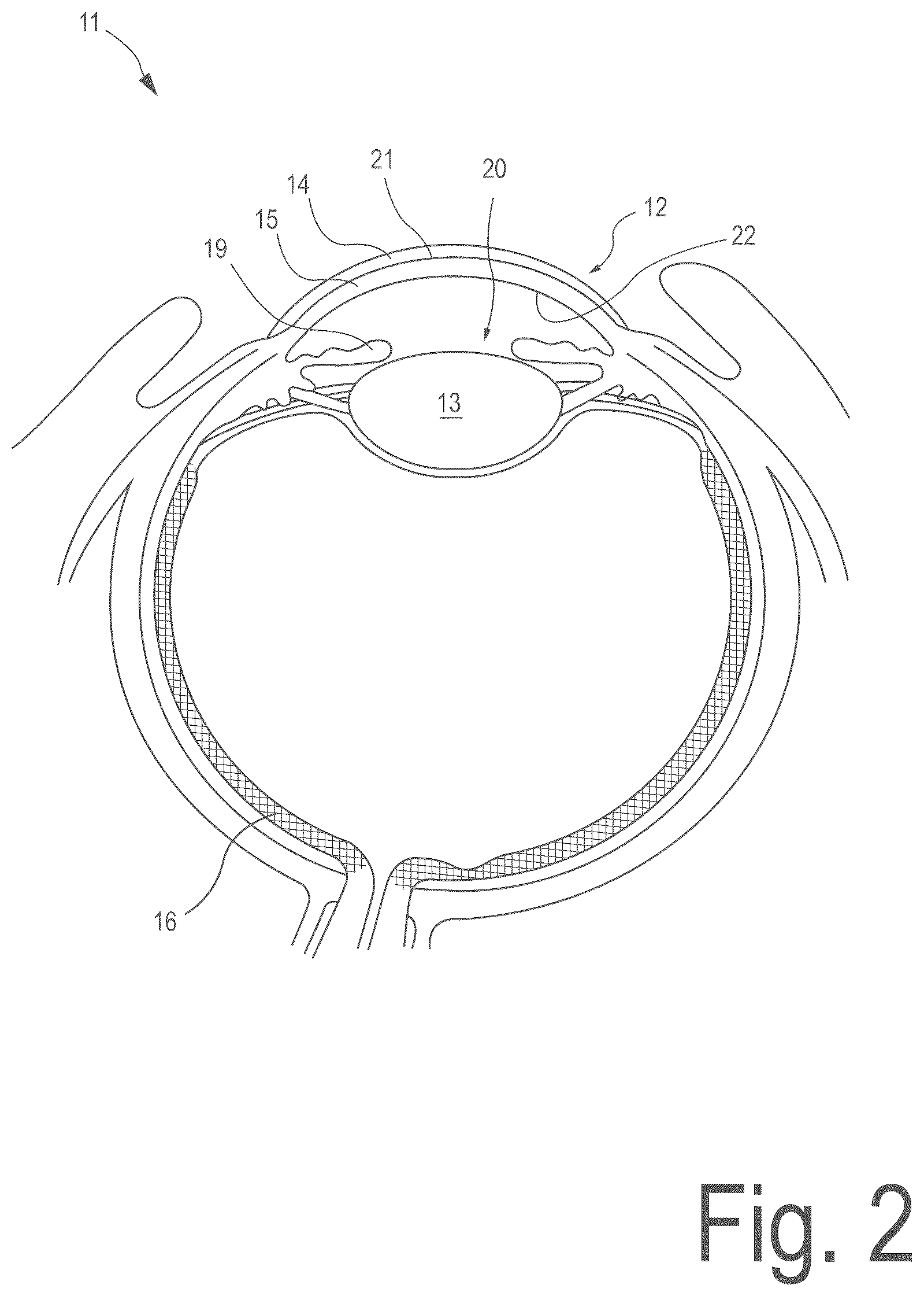 Patent US12496225 Figure 2 – Corneal refractive correction using a surface treatment after corneal reshaping