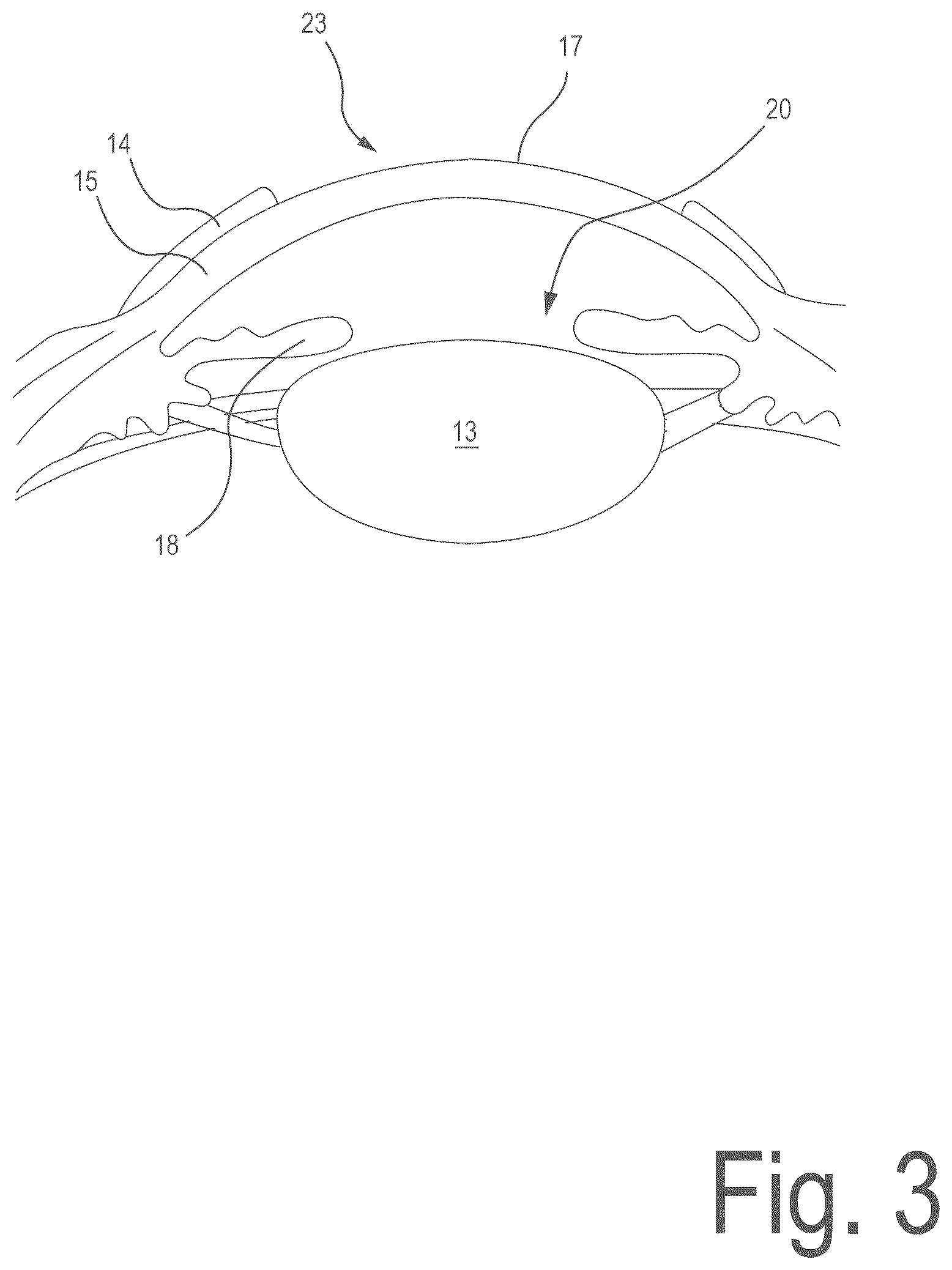 Patent US12496225 Figure 3 – Corneal refractive correction using a surface treatment after corneal reshaping