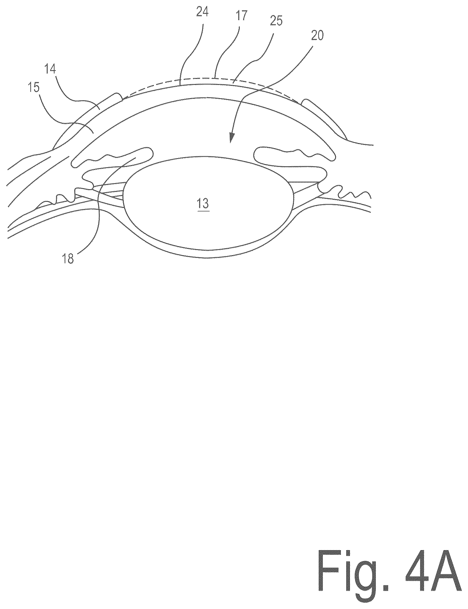 Patent US12496225 Figure 4 – Corneal refractive correction using a surface treatment after corneal reshaping