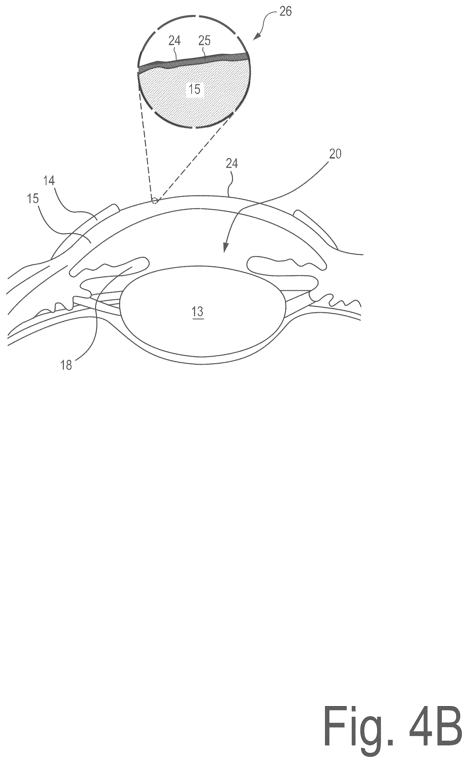 Patent US12496225 Figure 5 – Corneal refractive correction using a surface treatment after corneal reshaping