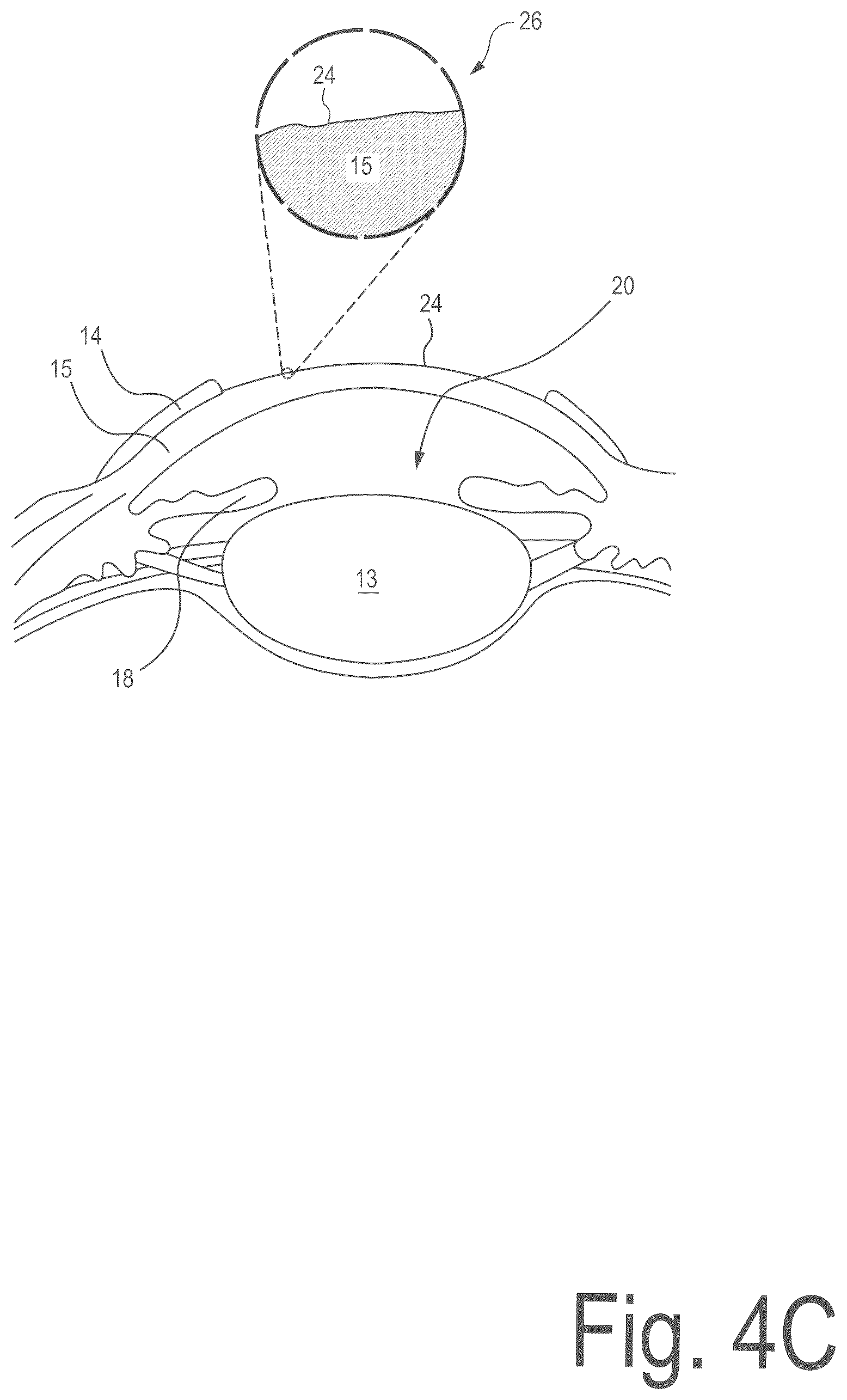 Patent US12496225 Figure 6 – Corneal refractive correction using a surface treatment after corneal reshaping