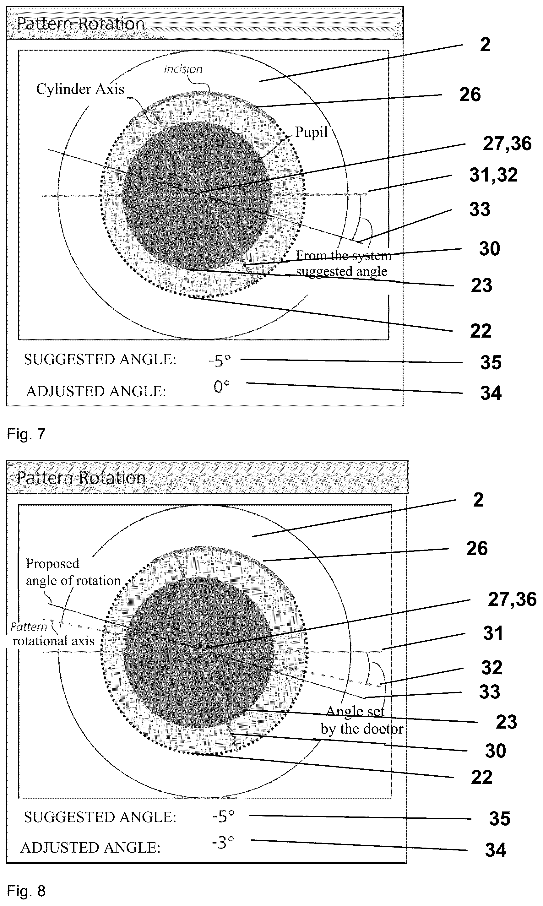 Patent US12496226 Figure 4 – Eye-surgical treatment apparatus