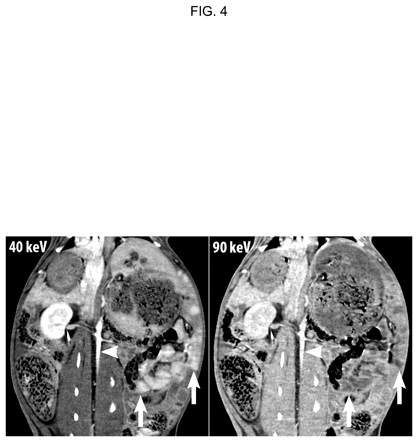 Patent US12496362 Figure 4 – Silicone-based enteric CT contrast material