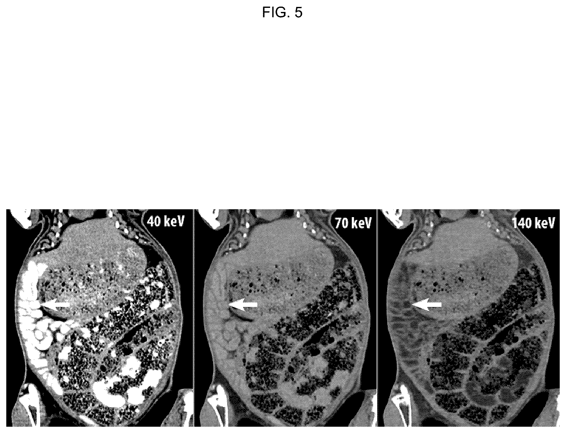 Patent US12496362 Figure 5 – Silicone-based enteric CT contrast material