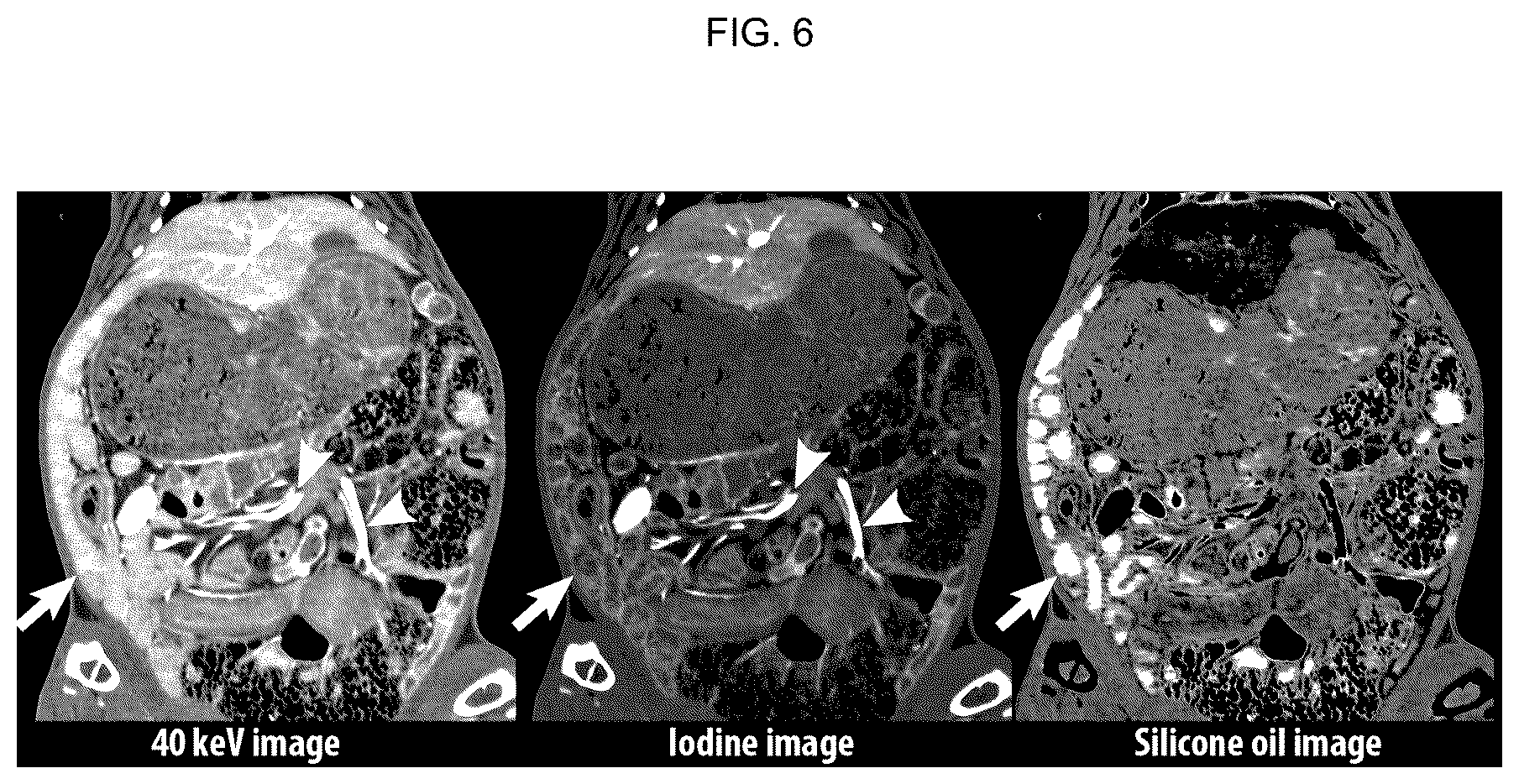 Patent US12496362 Figure 6 – Silicone-based enteric CT contrast material