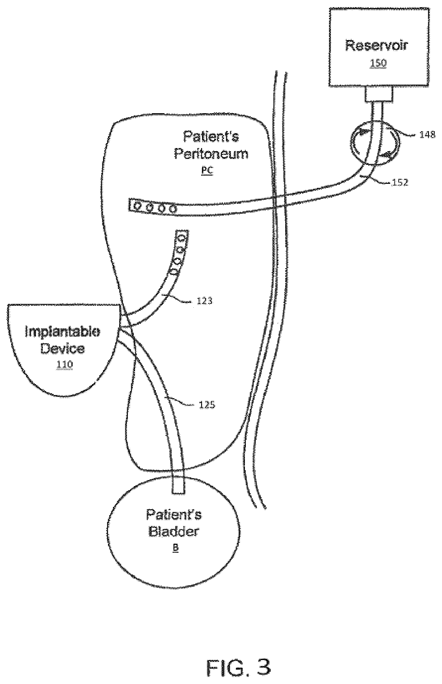 Patent US12496384 Figure 3 – Formulations and methods for direct sodium removal in patients having heart failure and/or severe renal dysfunction