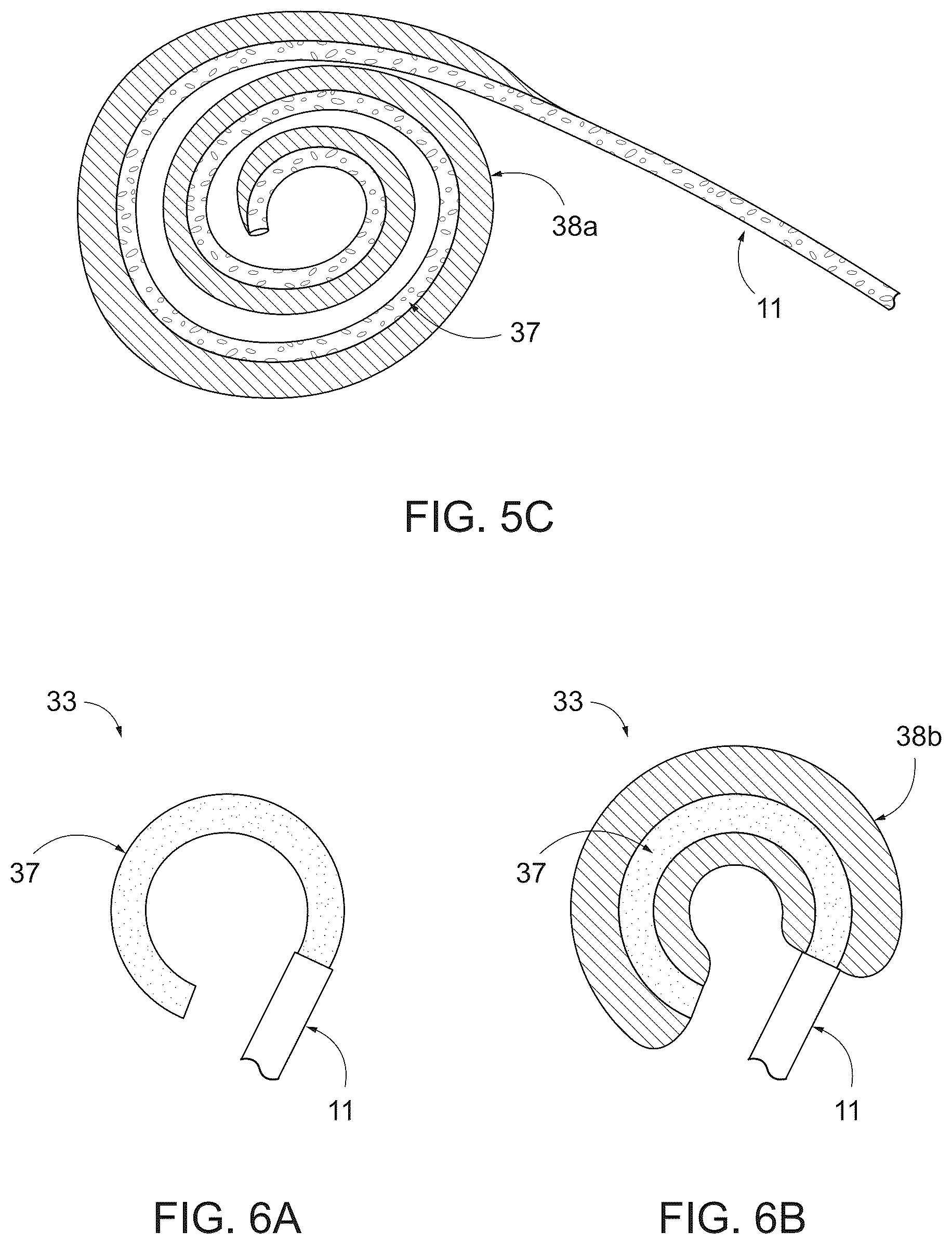 Patent US12496385 Figure 5 – Peritoneal dialysis catheter with an expandable structure