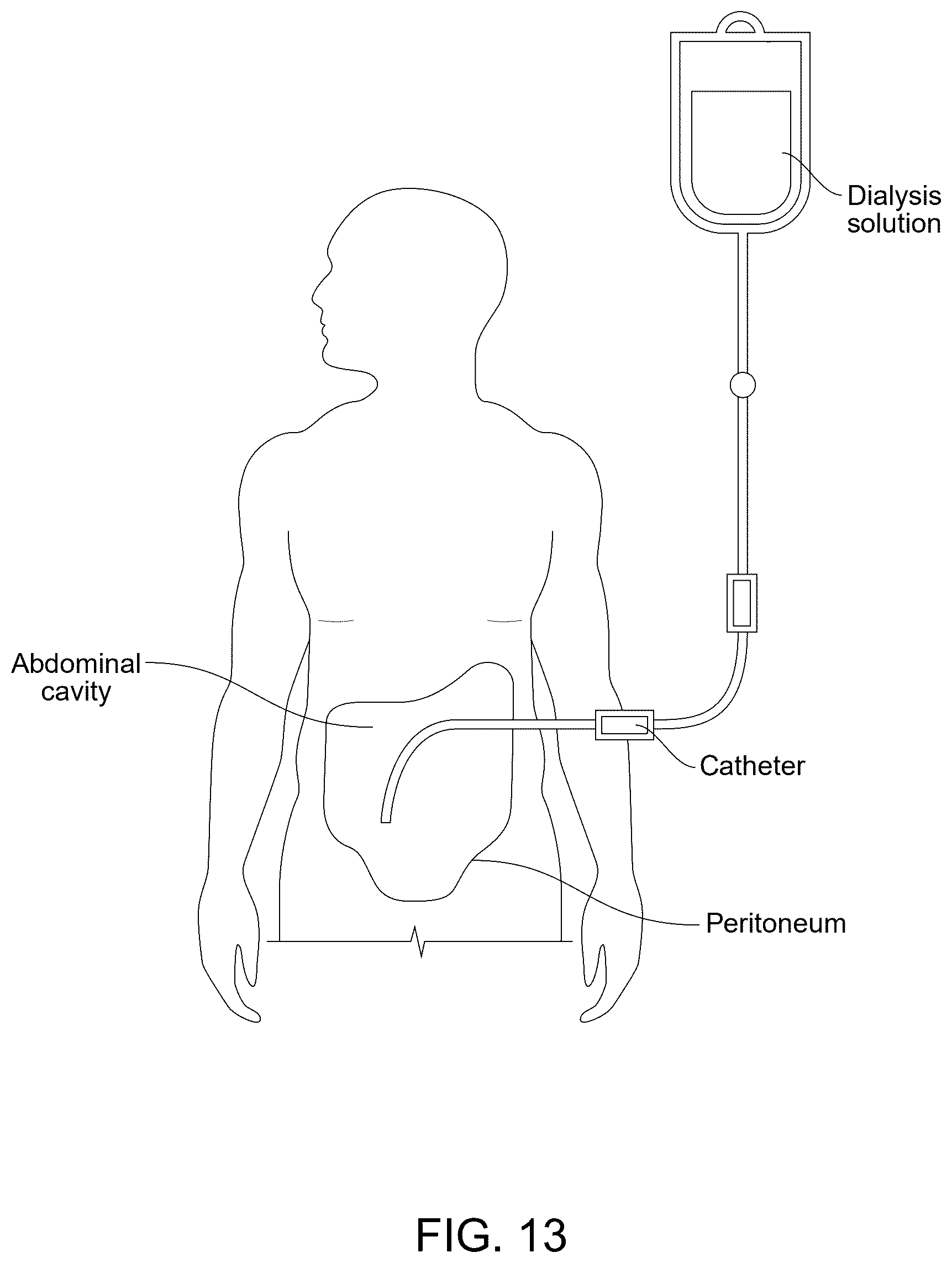 Patent US12496385 Figure 18 – Peritoneal dialysis catheter with an expandable structure