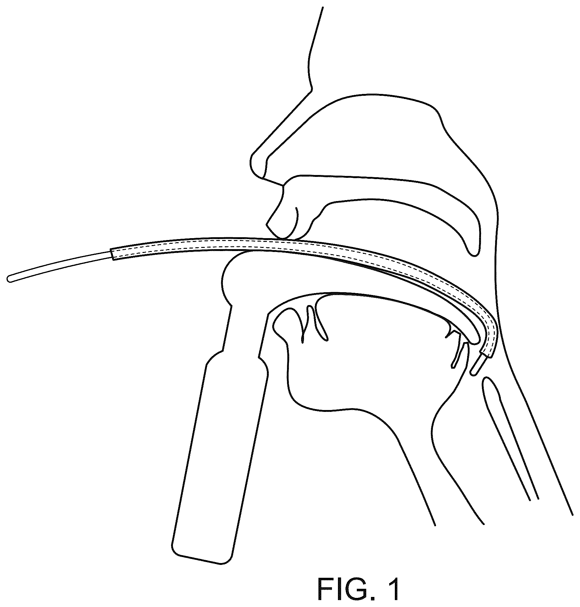 Patent US12496416 Figure 1 – Tracheal introducer sheath