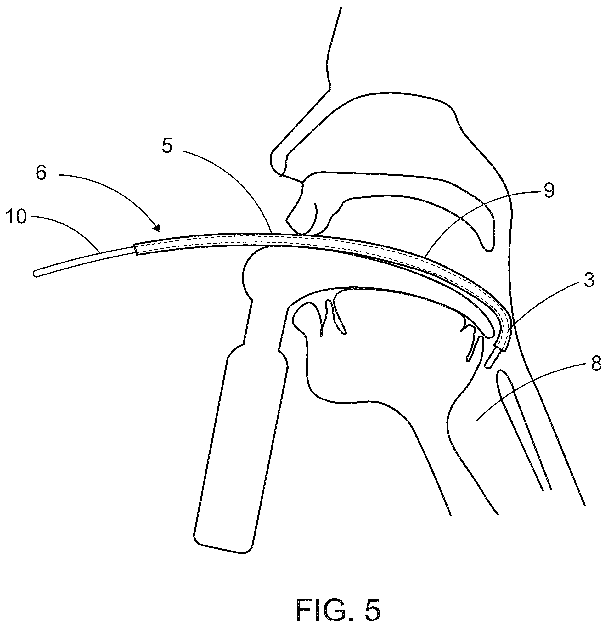 Patent US12496416 Figure 5 – Tracheal introducer sheath