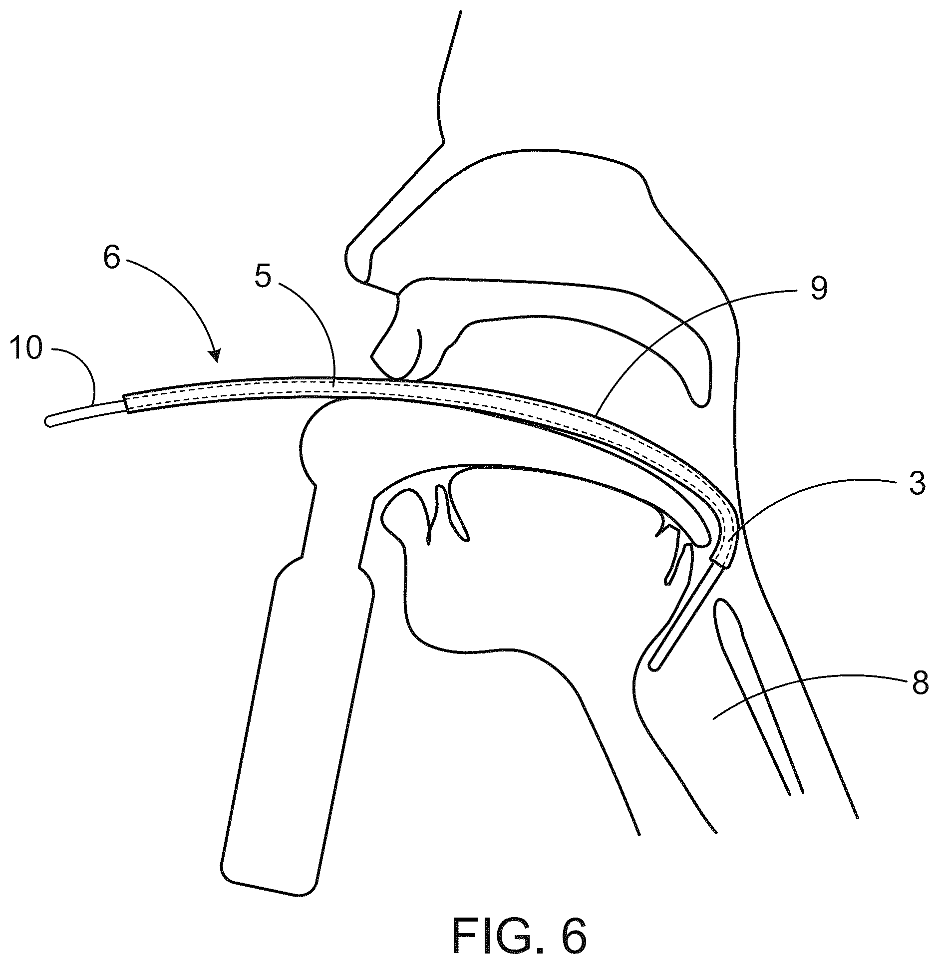 Patent US12496416 Figure 6 – Tracheal introducer sheath