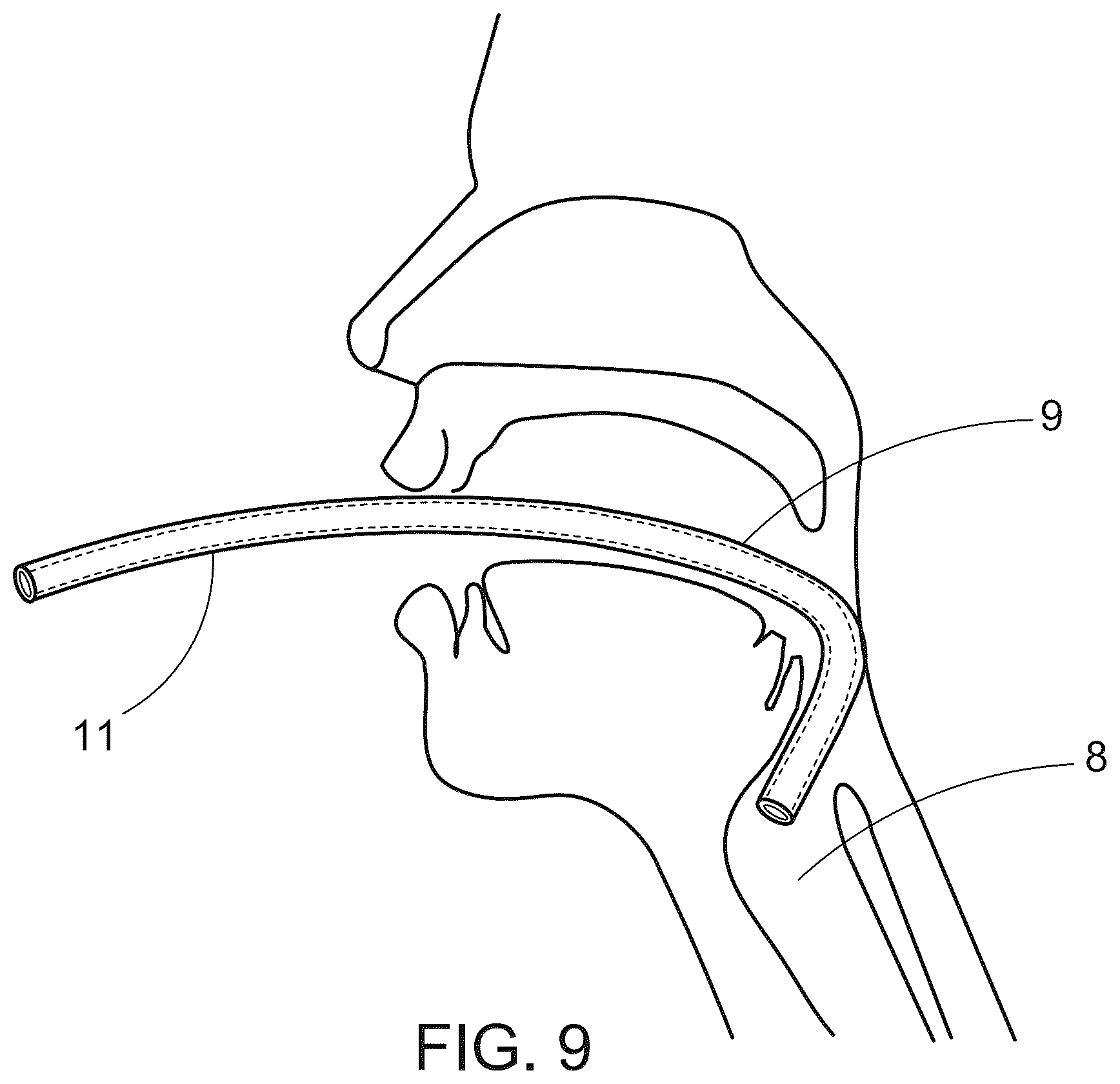 Patent US12496416 Figure 9 – Tracheal introducer sheath