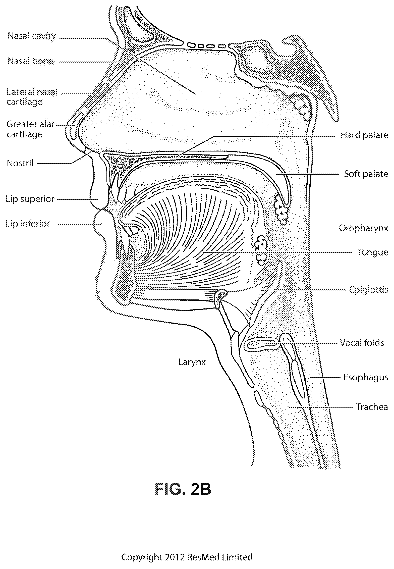 Patent US12496420 Figure 5 – Vent for a respiratory pressure therapy system
