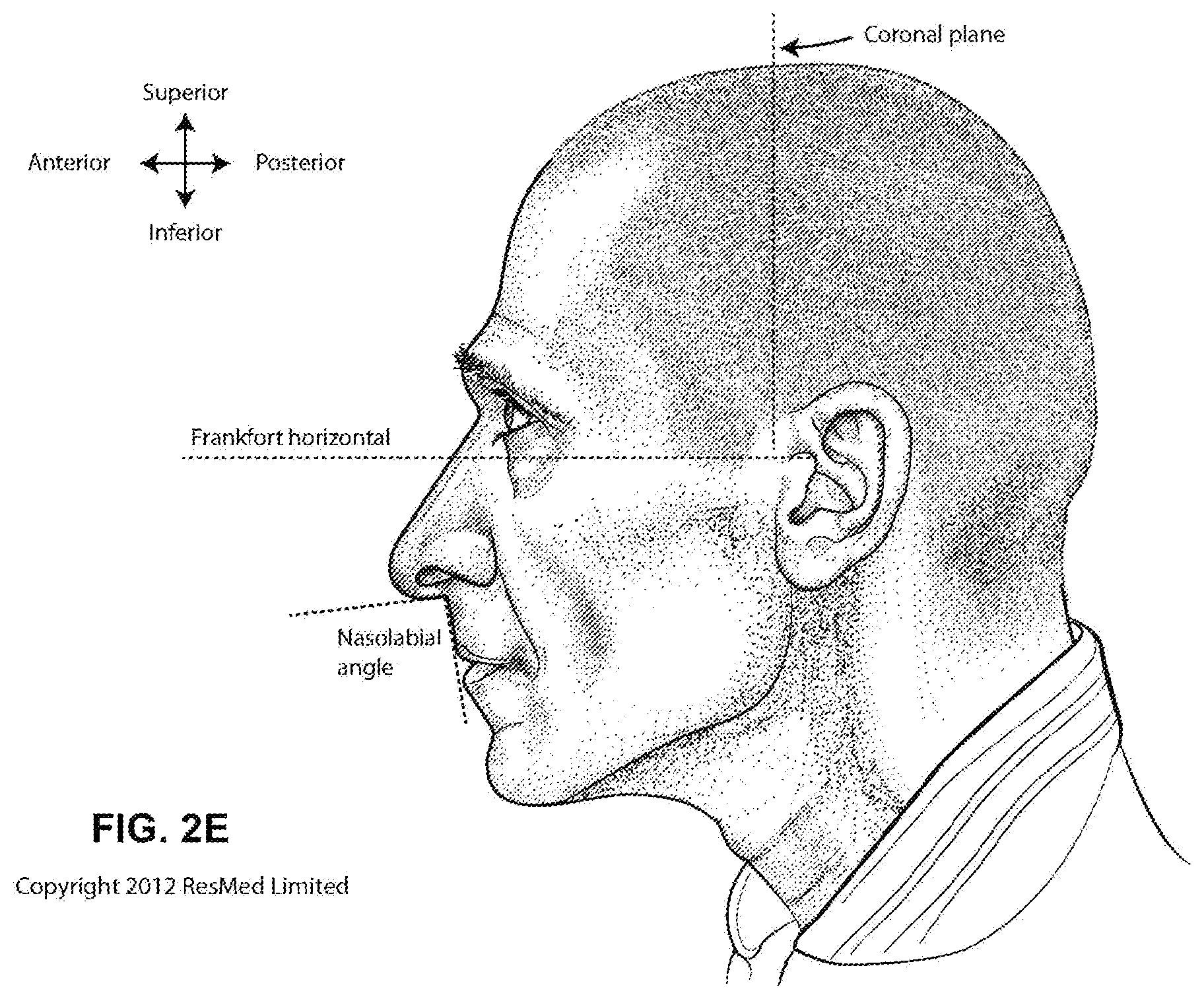 Patent US12496420 Figure 8 – Vent for a respiratory pressure therapy system