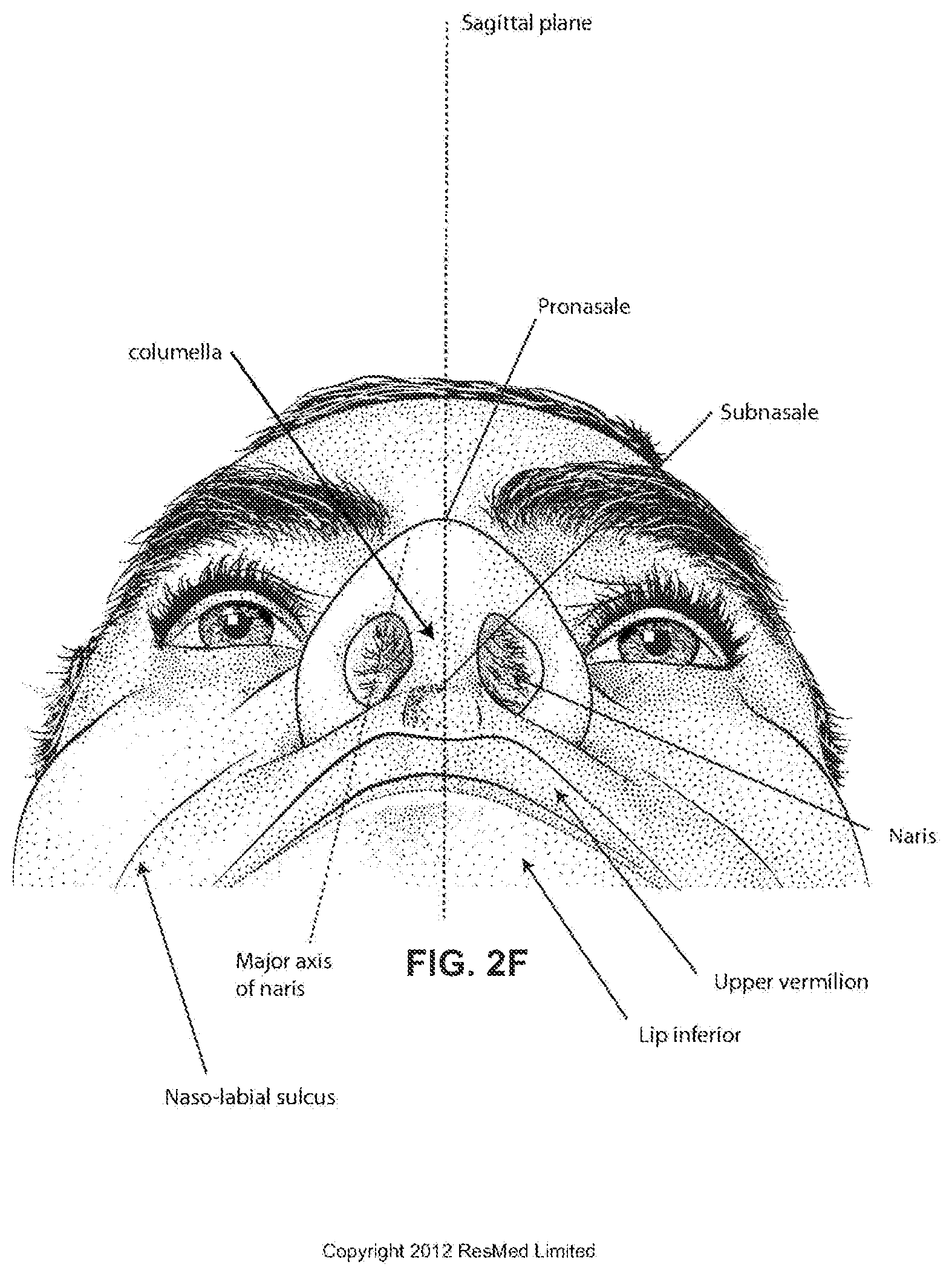 Patent US12496420 Figure 9 – Vent for a respiratory pressure therapy system