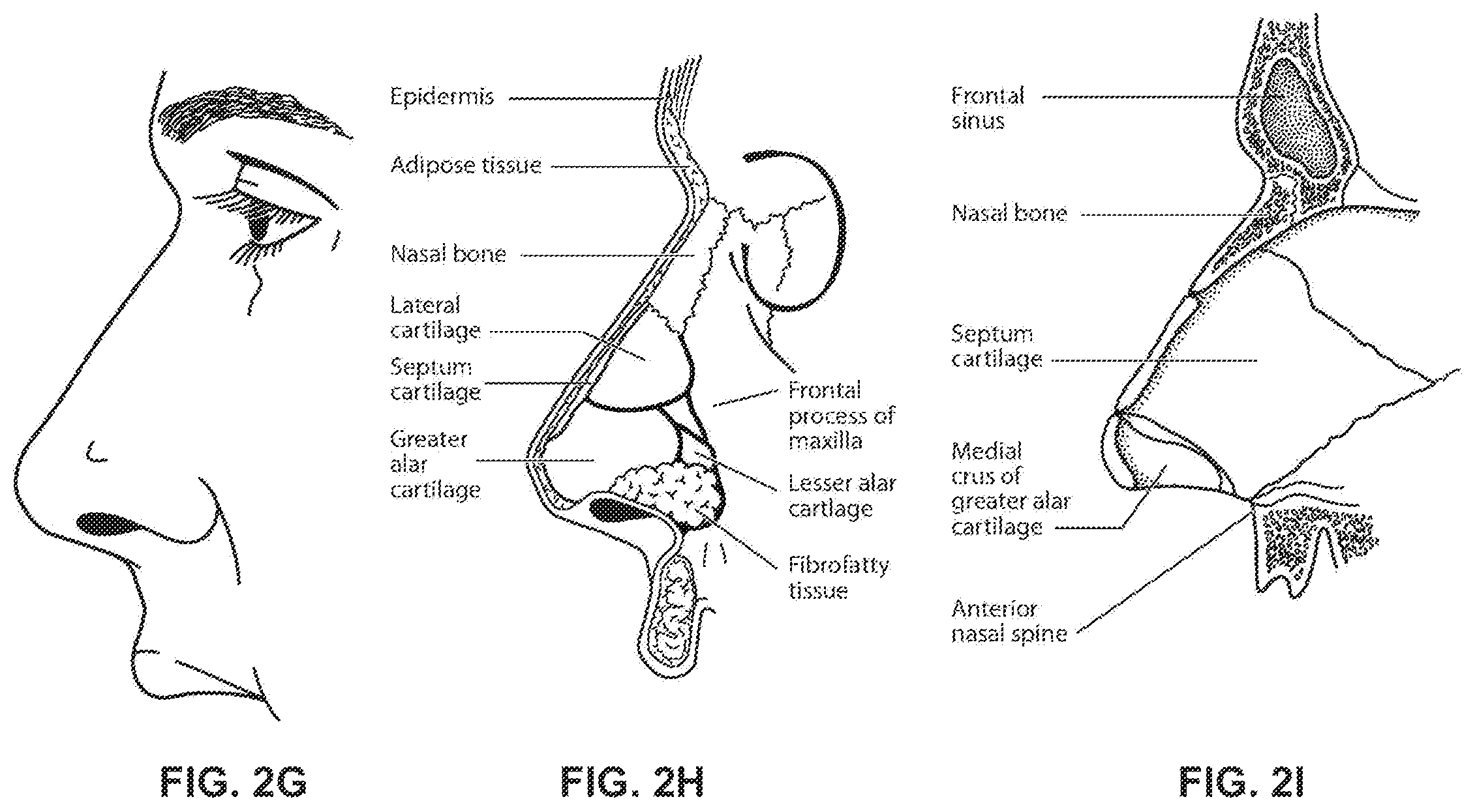 Patent US12496420 Figure 10 – Vent for a respiratory pressure therapy system