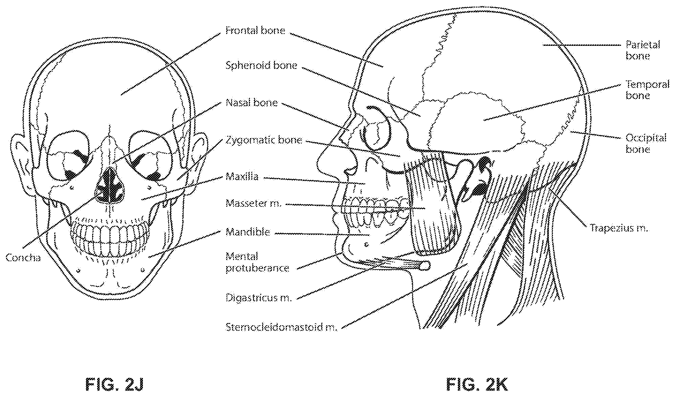 Patent US12496420 Figure 11 – Vent for a respiratory pressure therapy system