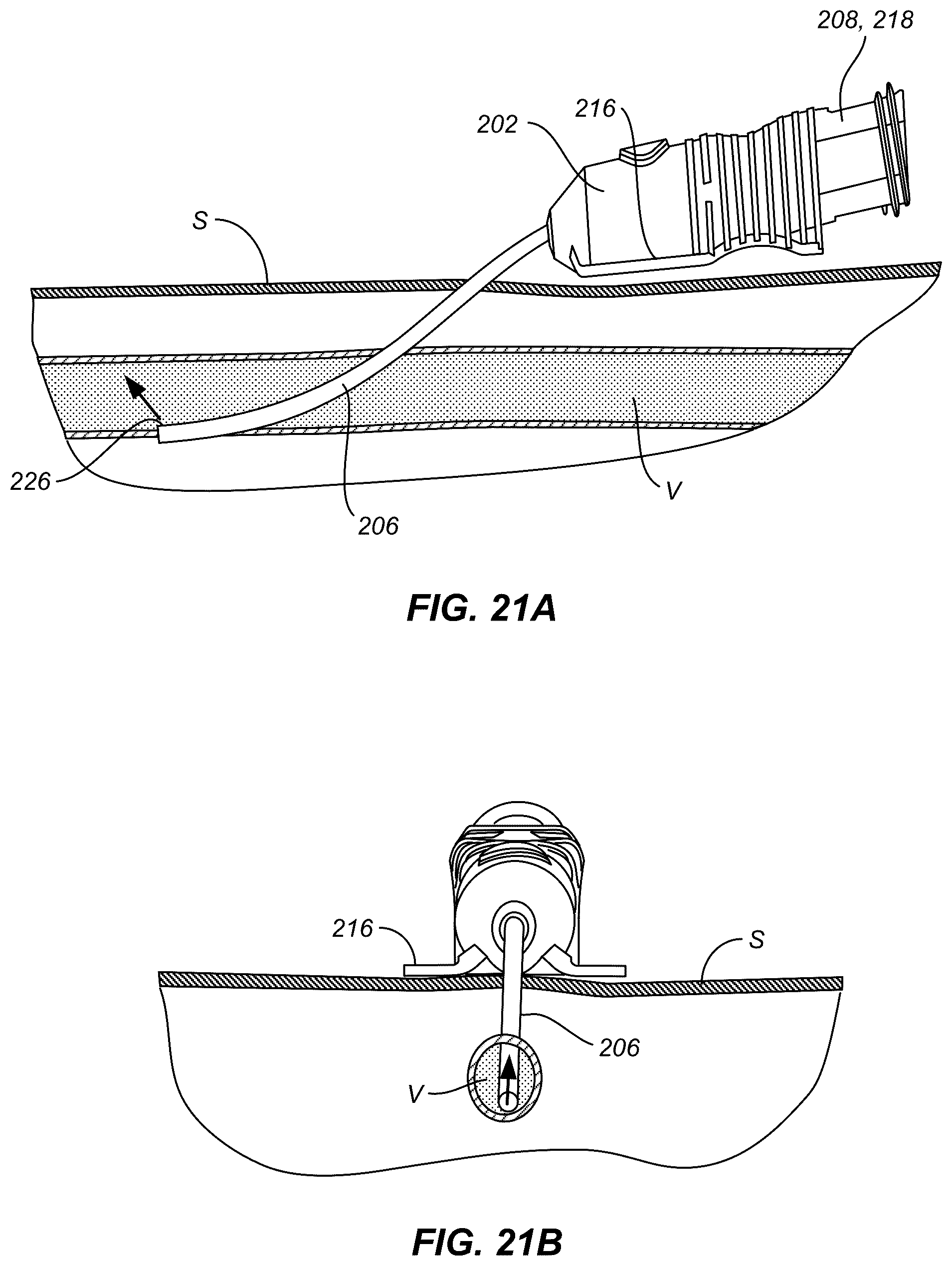 Patent US12496434 Figure 20 – Retractable needle catheter delivery apparatus