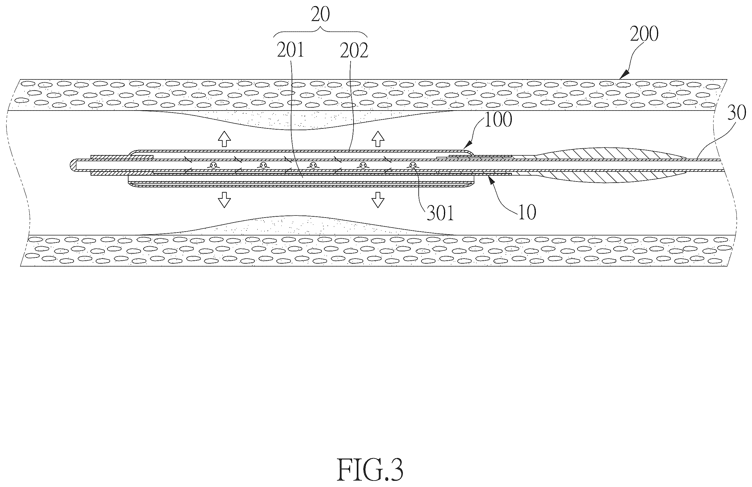 Patent US12496436 Figure 2 – Hollow balloon catheter device for guiding blood flow