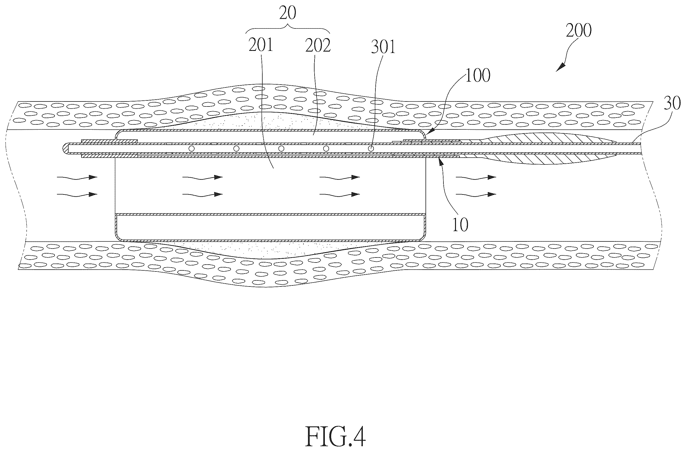 Patent US12496436 Figure 3 – Hollow balloon catheter device for guiding blood flow
