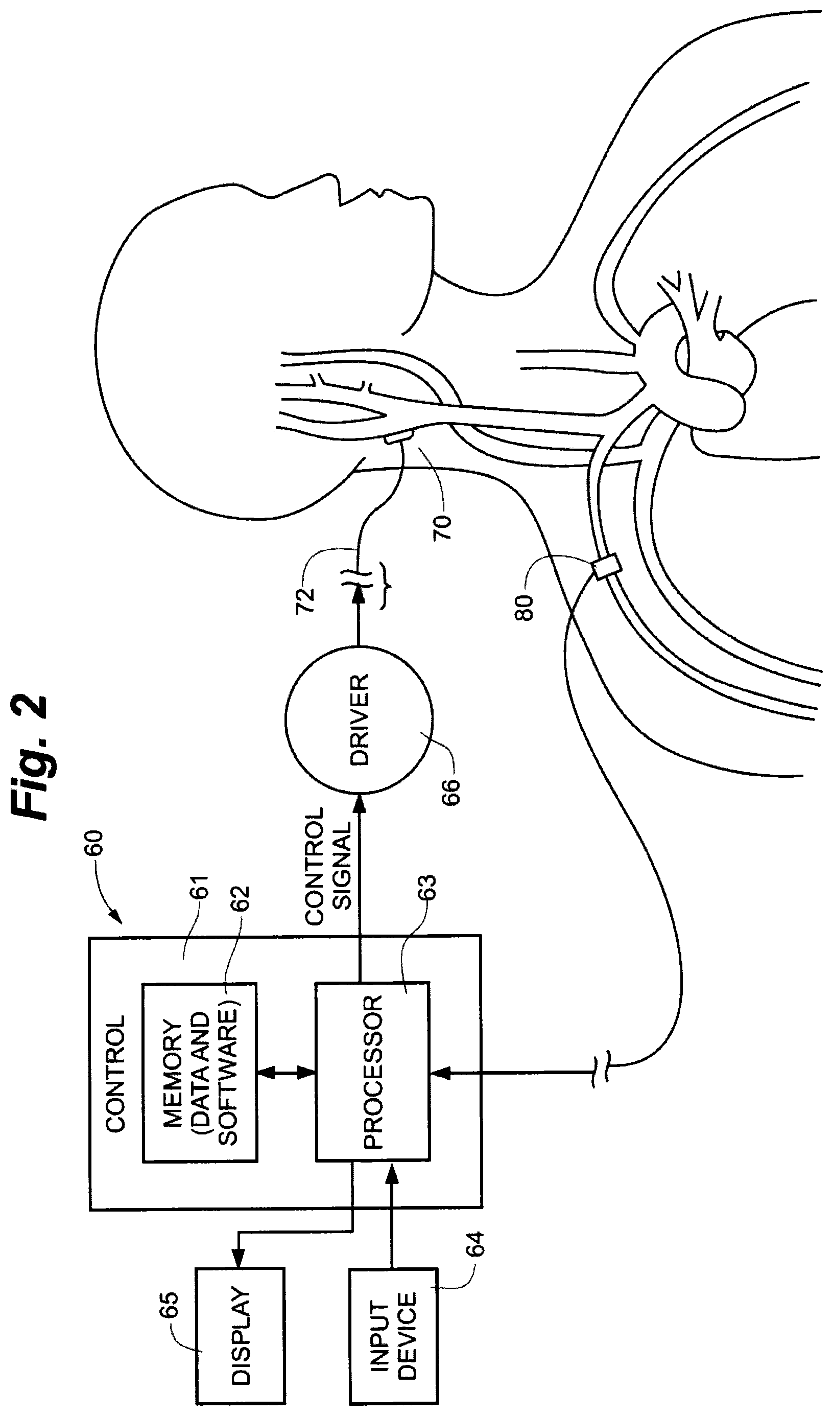 Patent US12496439 Figure 2 – Implant tool and improved electrode design for minimally invasive procedure